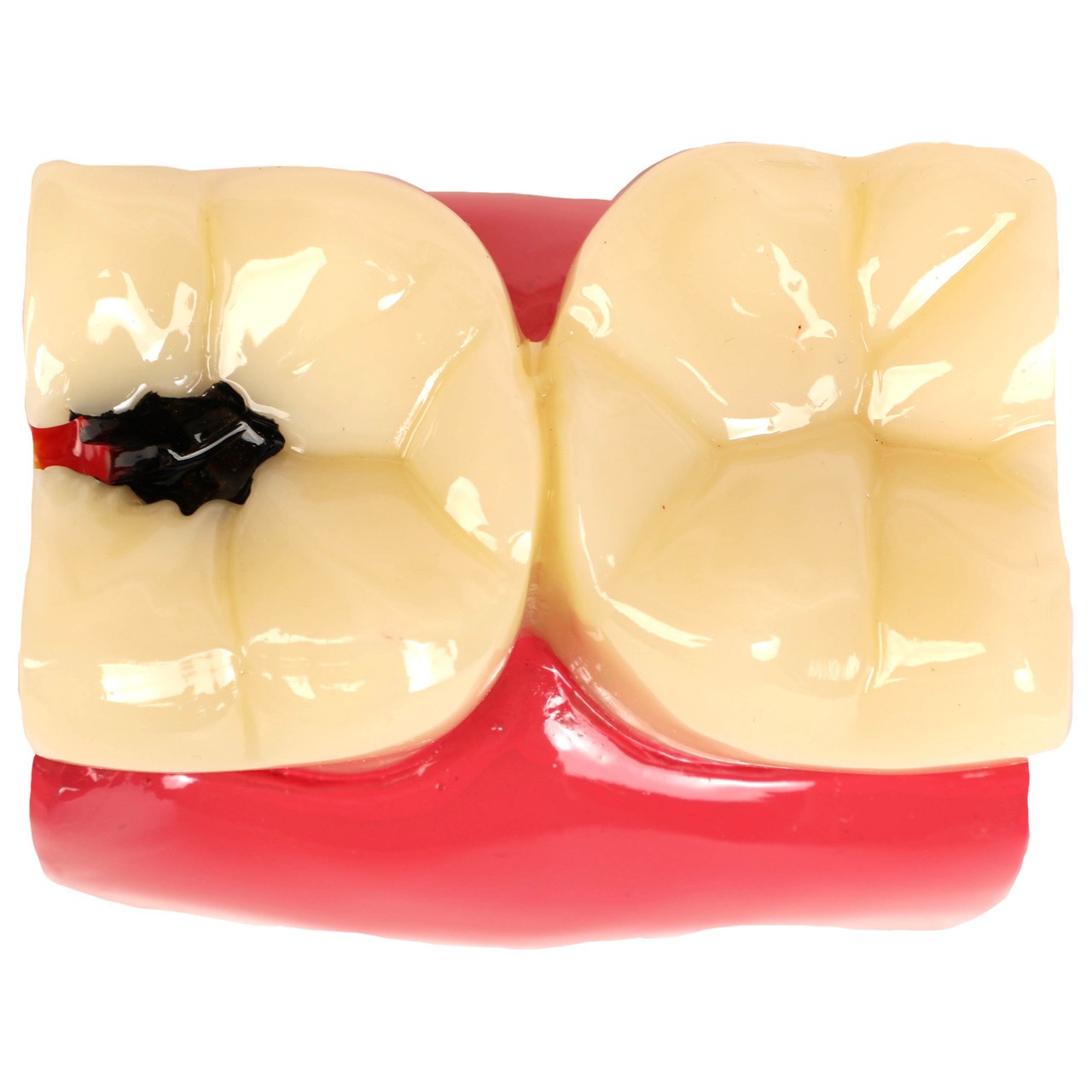 Axis Scientific Decayed Teeth Comparison Anatomy Model, 6x Life-Size