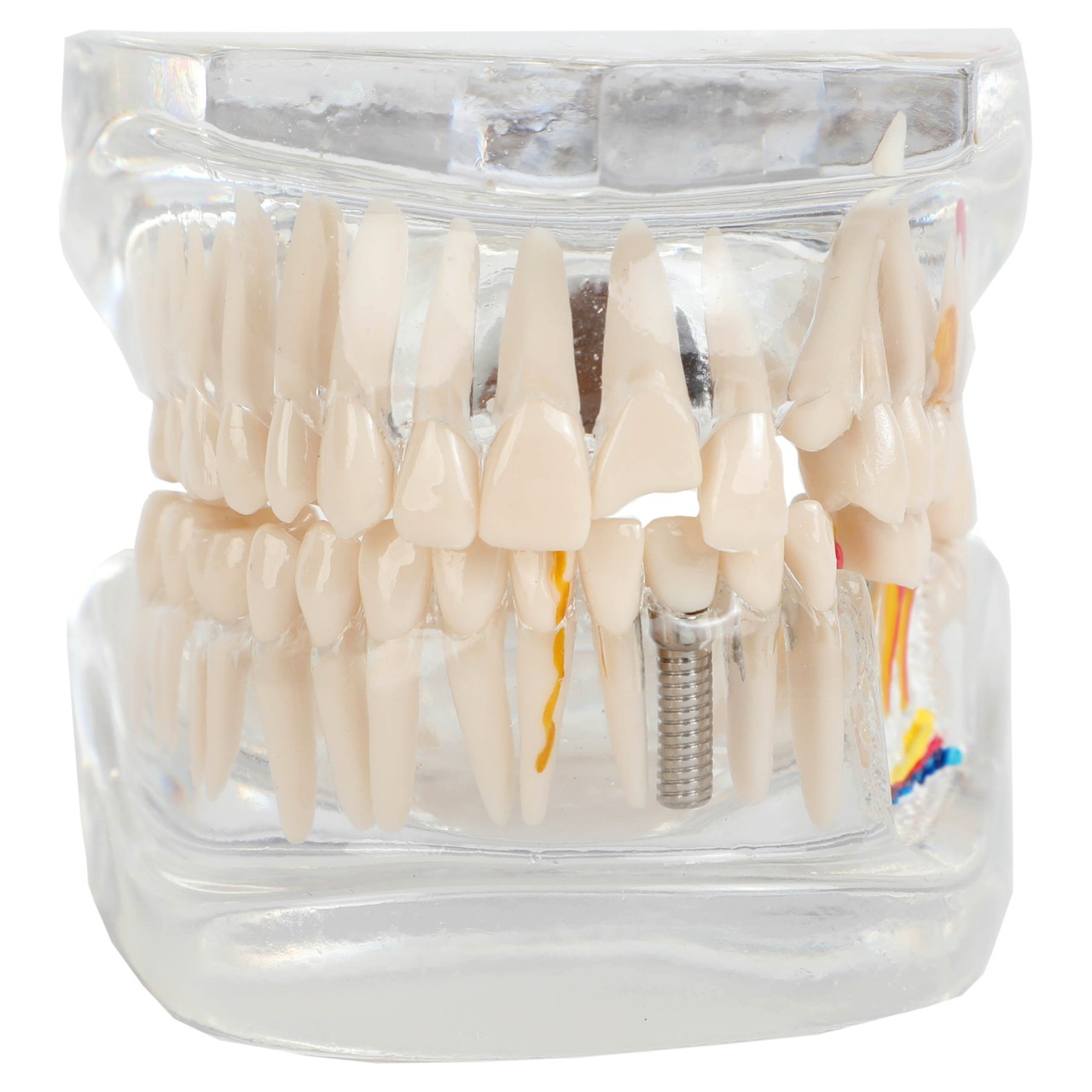 Axis Scientific Transparent Diseased Teeth Anatomy Model