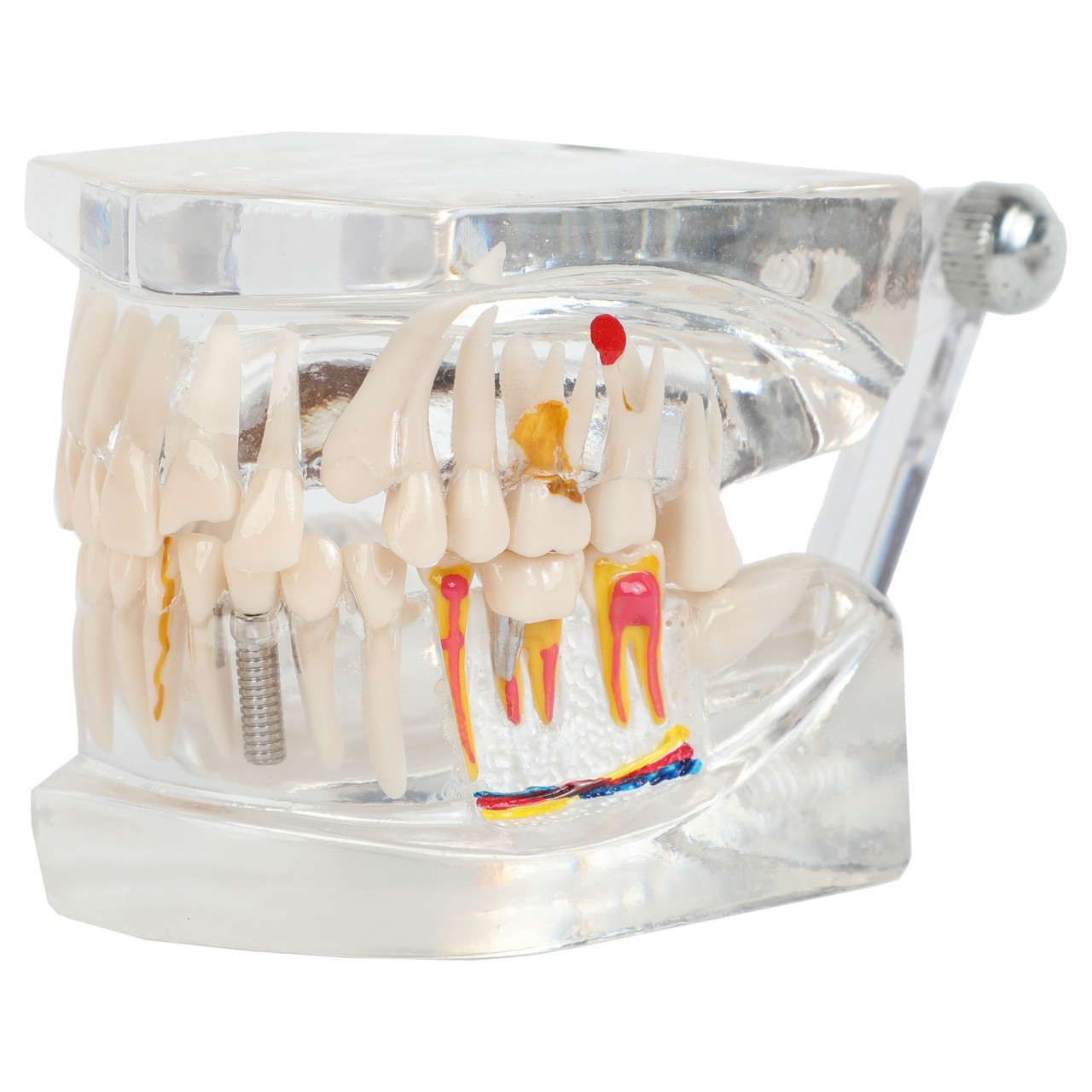 Axis Scientific Transparent Diseased Teeth Anatomy Model