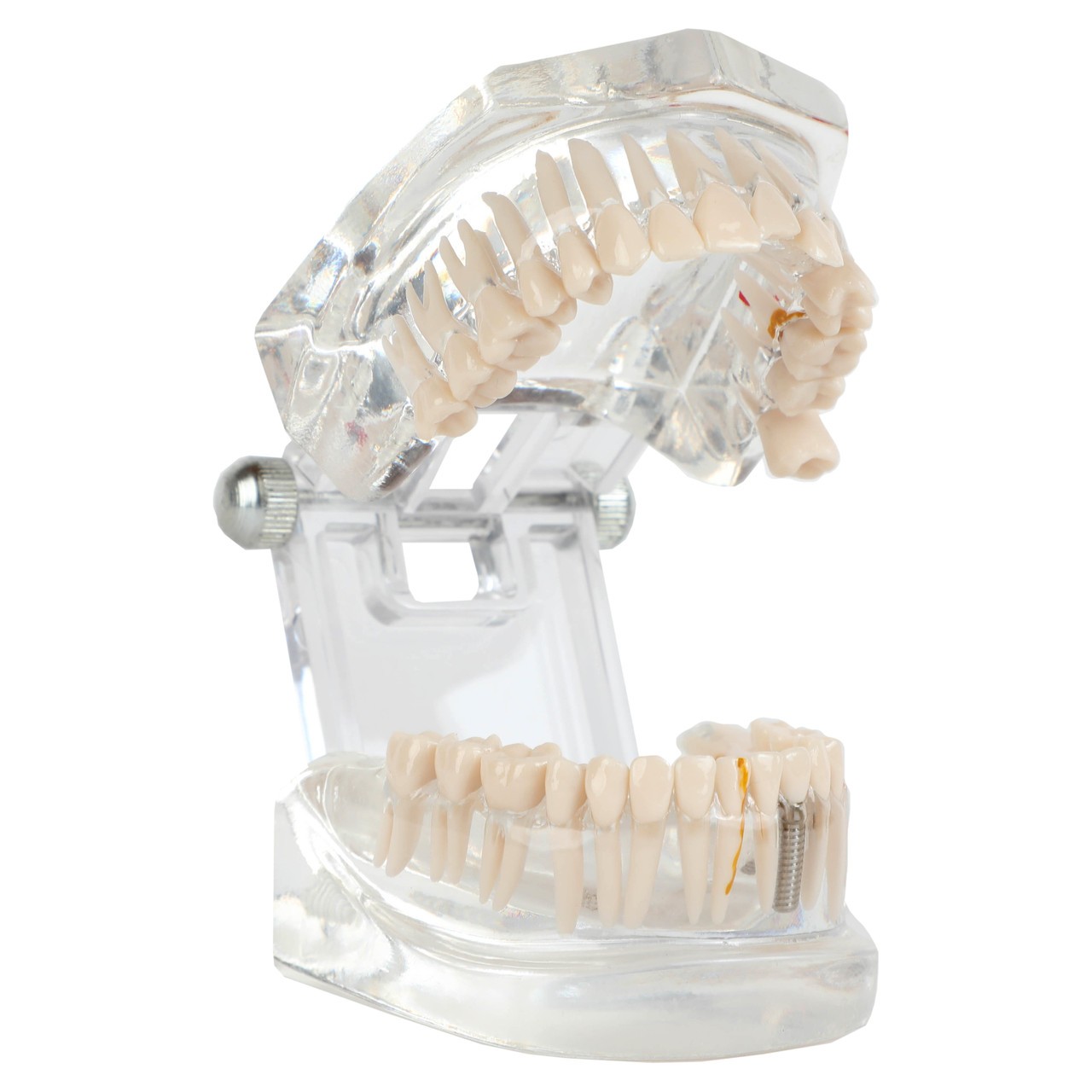 Axis Scientific Transparent Diseased Teeth Anatomy Model