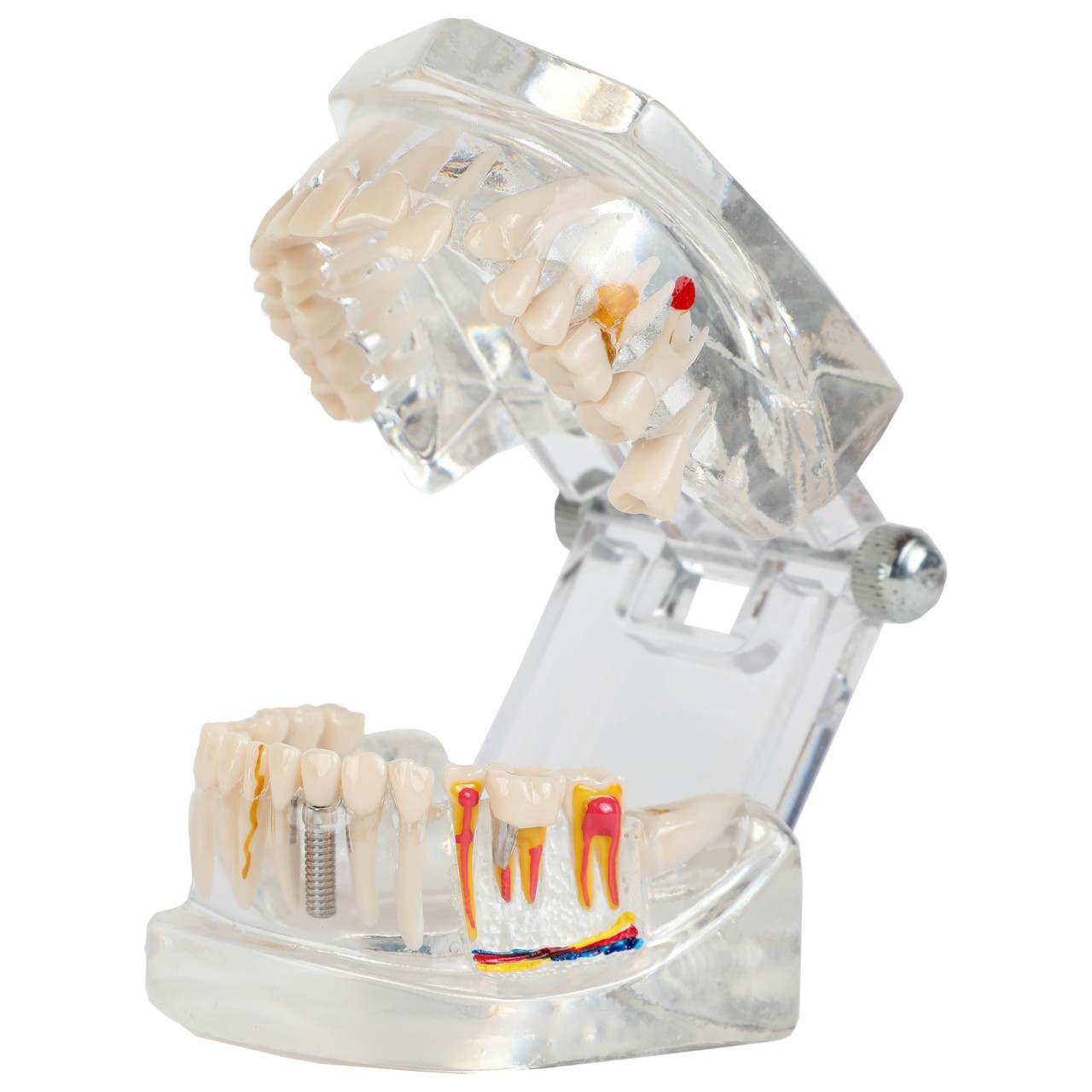 Axis Scientific Transparent Diseased Teeth Anatomy Model