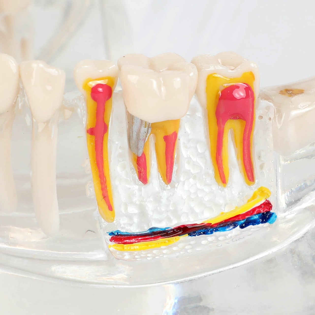 Axis Scientific Transparent Diseased Teeth Anatomy Model
