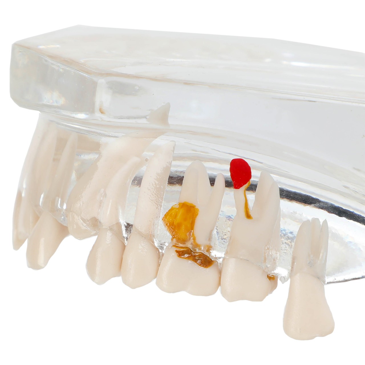 Axis Scientific Transparent Diseased Teeth Anatomy Model