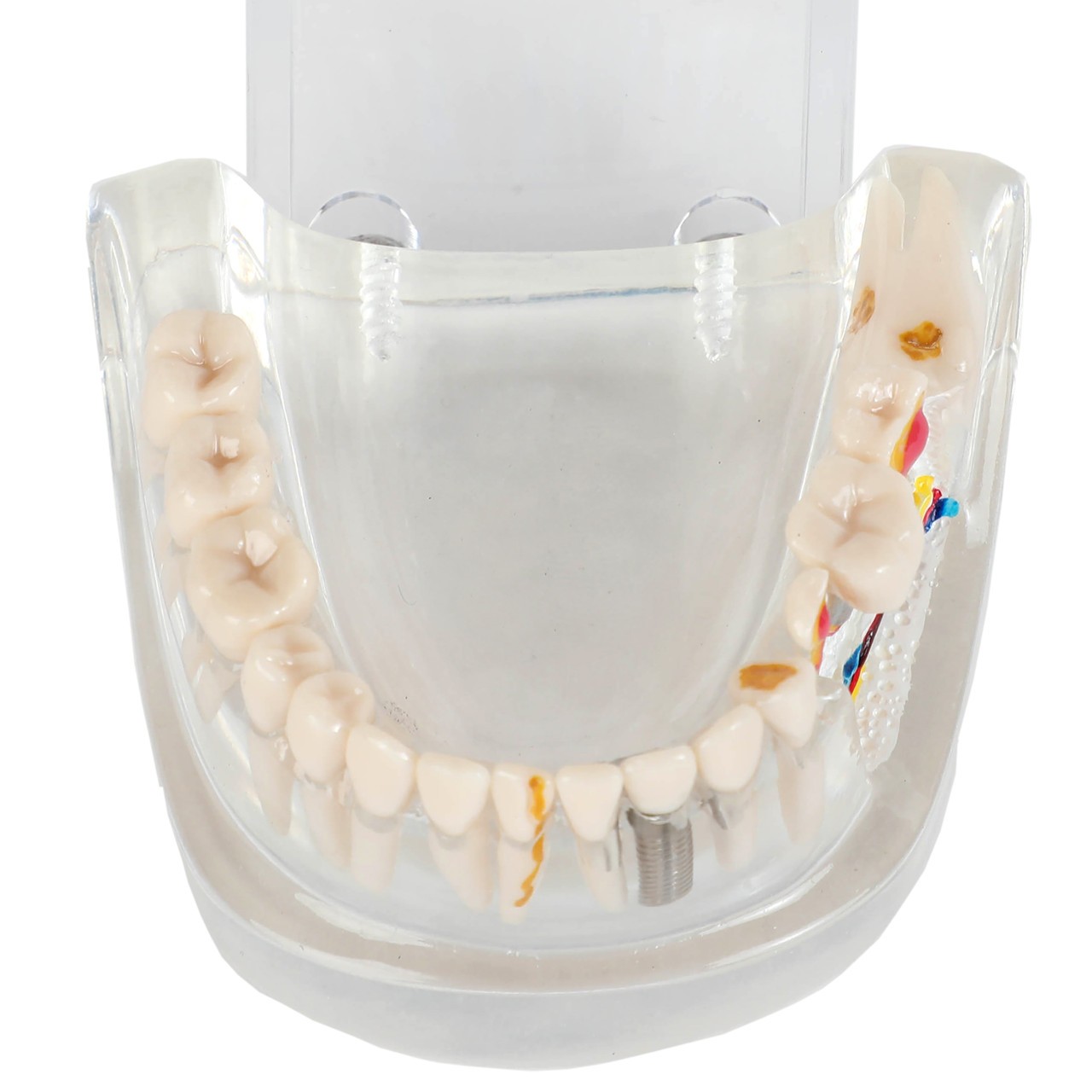 Axis Scientific Transparent Diseased Teeth Anatomy Model