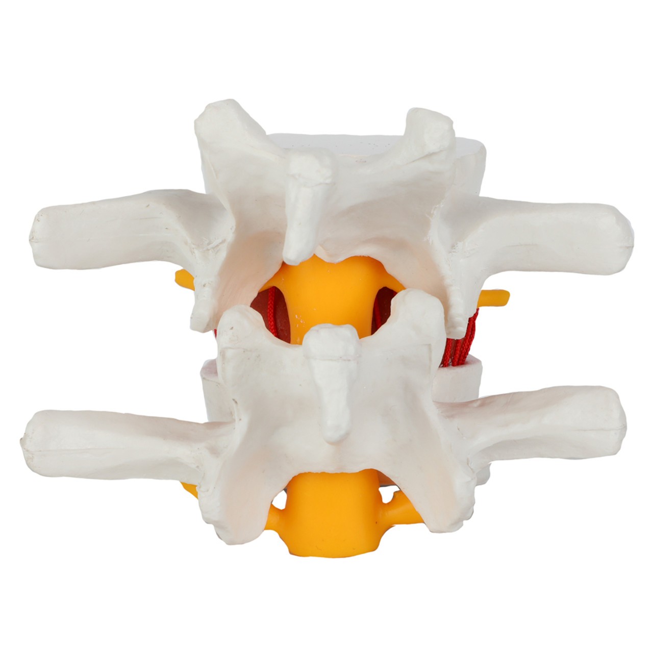 Axis Scientific Human Lumbar Herniating Disc Demonstration Anatomy Model - Back View with Spinal Nerves
