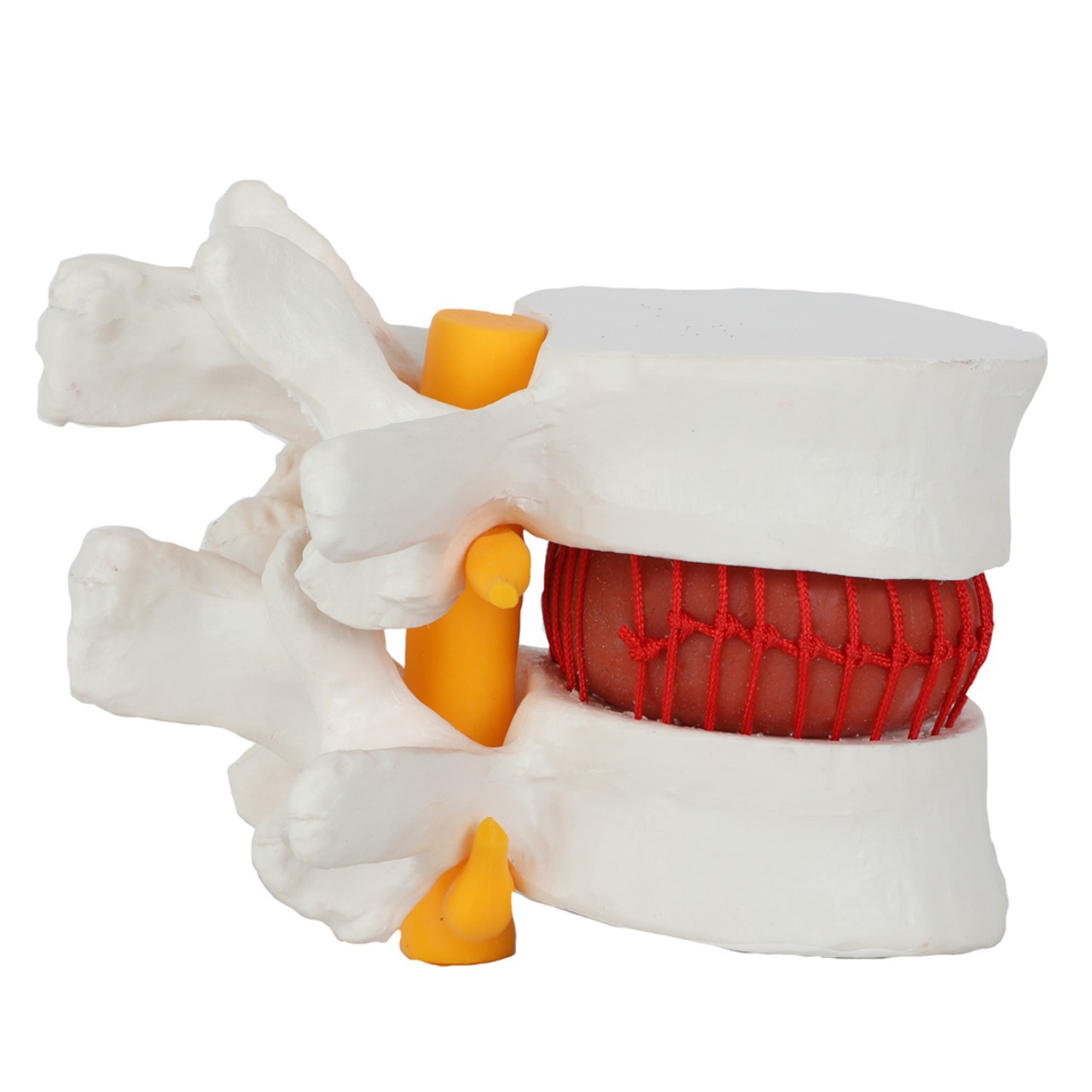 Axis Scientific Human Lumbar Herniating Disc Demonstration Anatomy Model - Right Side View with Spinal Nerves and Spinal Disk