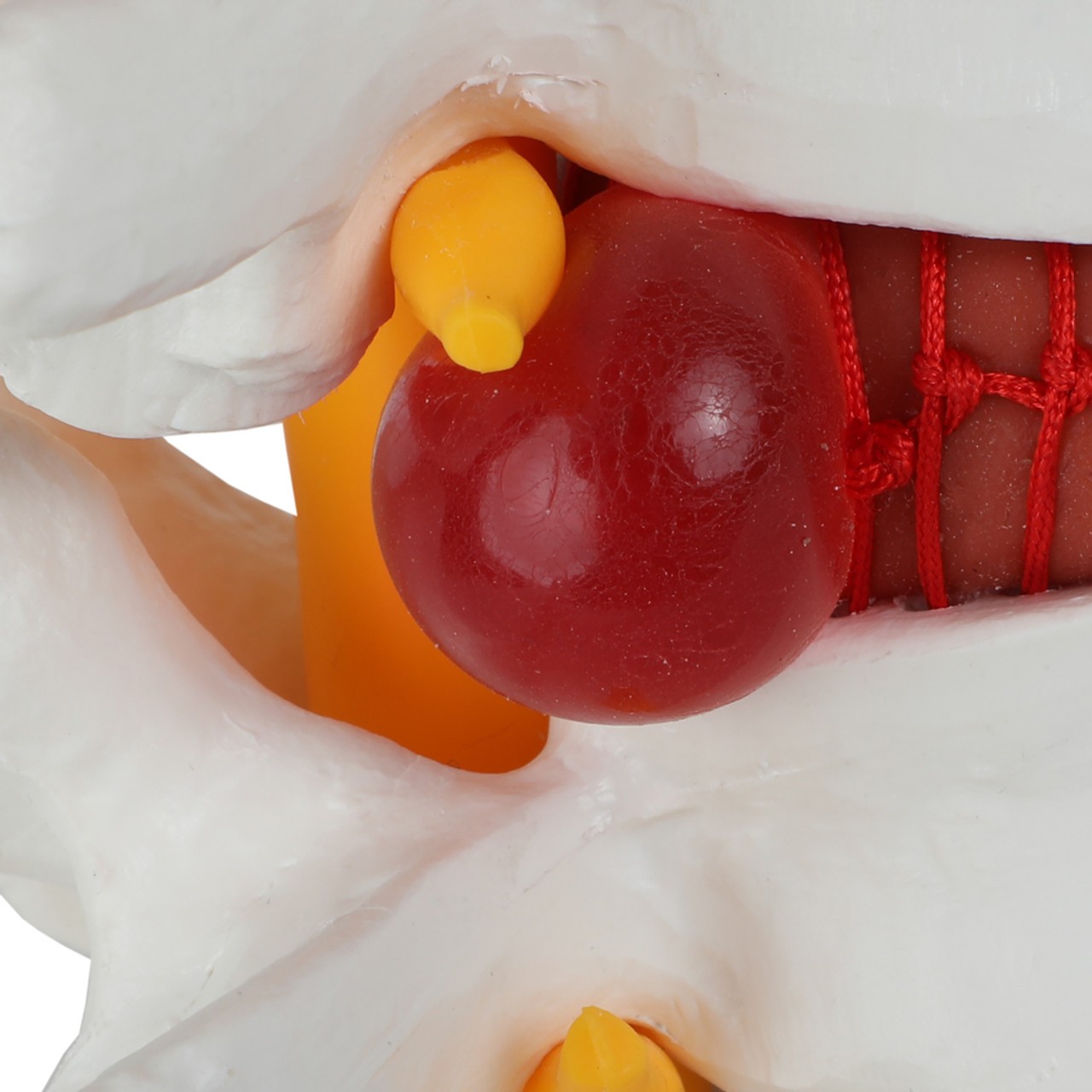 Axis Scientific Human Lumbar Herniating Disc Demonstration Anatomy Model - Lumbar Vertebrae Compressing Disk into Hernia
