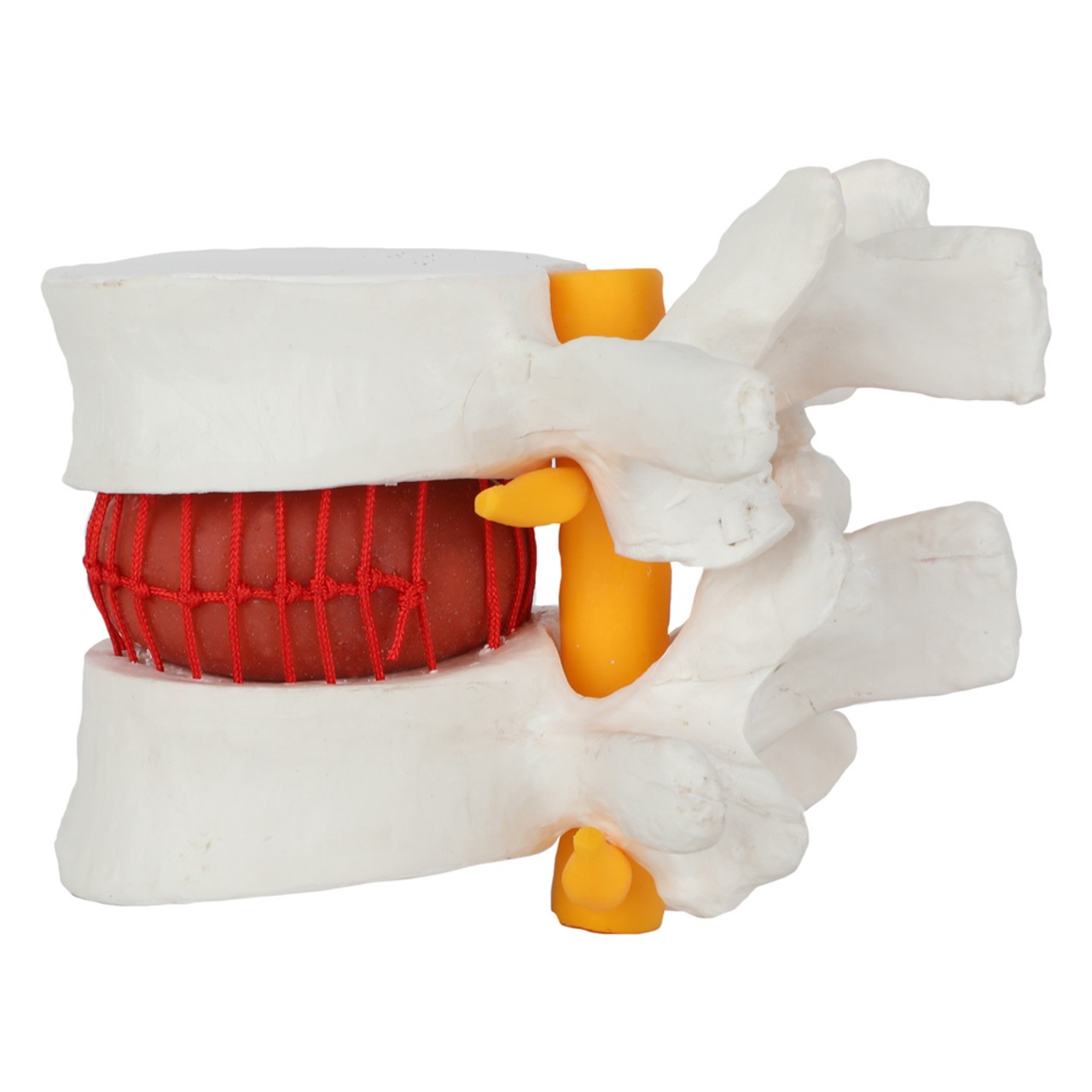 Axis Scientific Human Lumbar Herniating Disc Demonstration Anatomy Model - Left Side View with Spinal Nerves and Spinal Disk