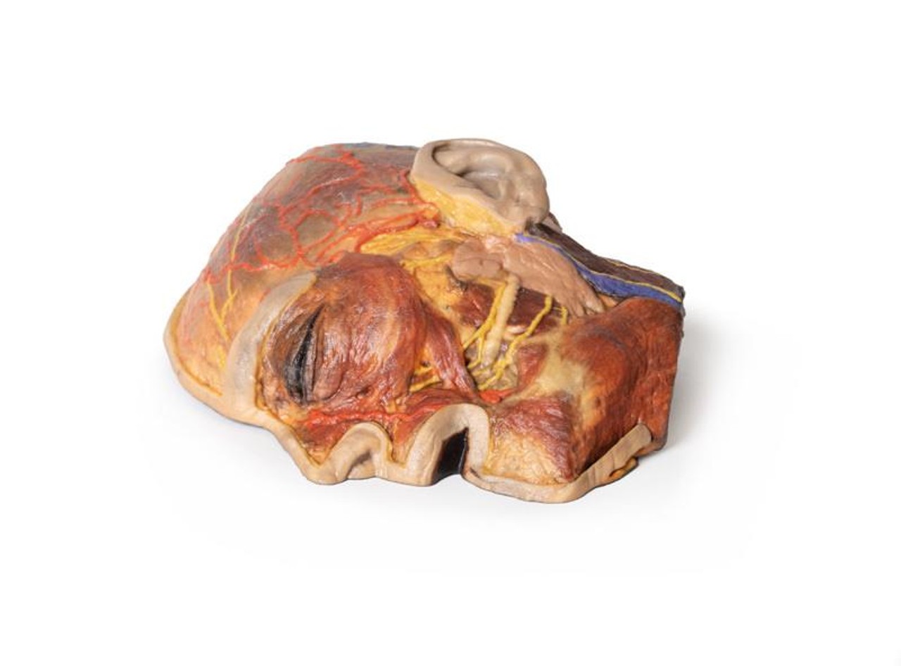 3D Printed Superficial Dissection of Facial Nerves and Parotid Gland