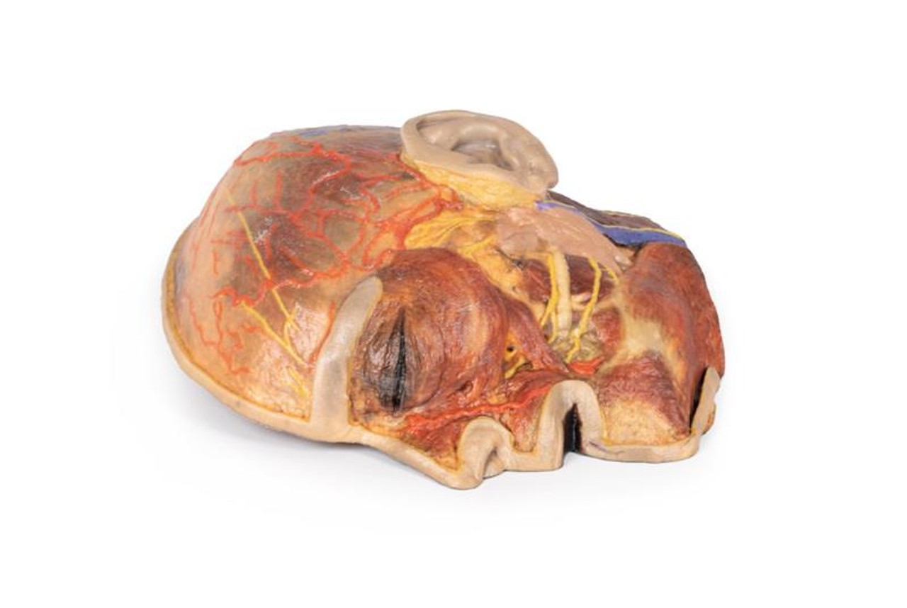 3D Printed Superficial Dissection of Facial Nerves and Parotid Gland