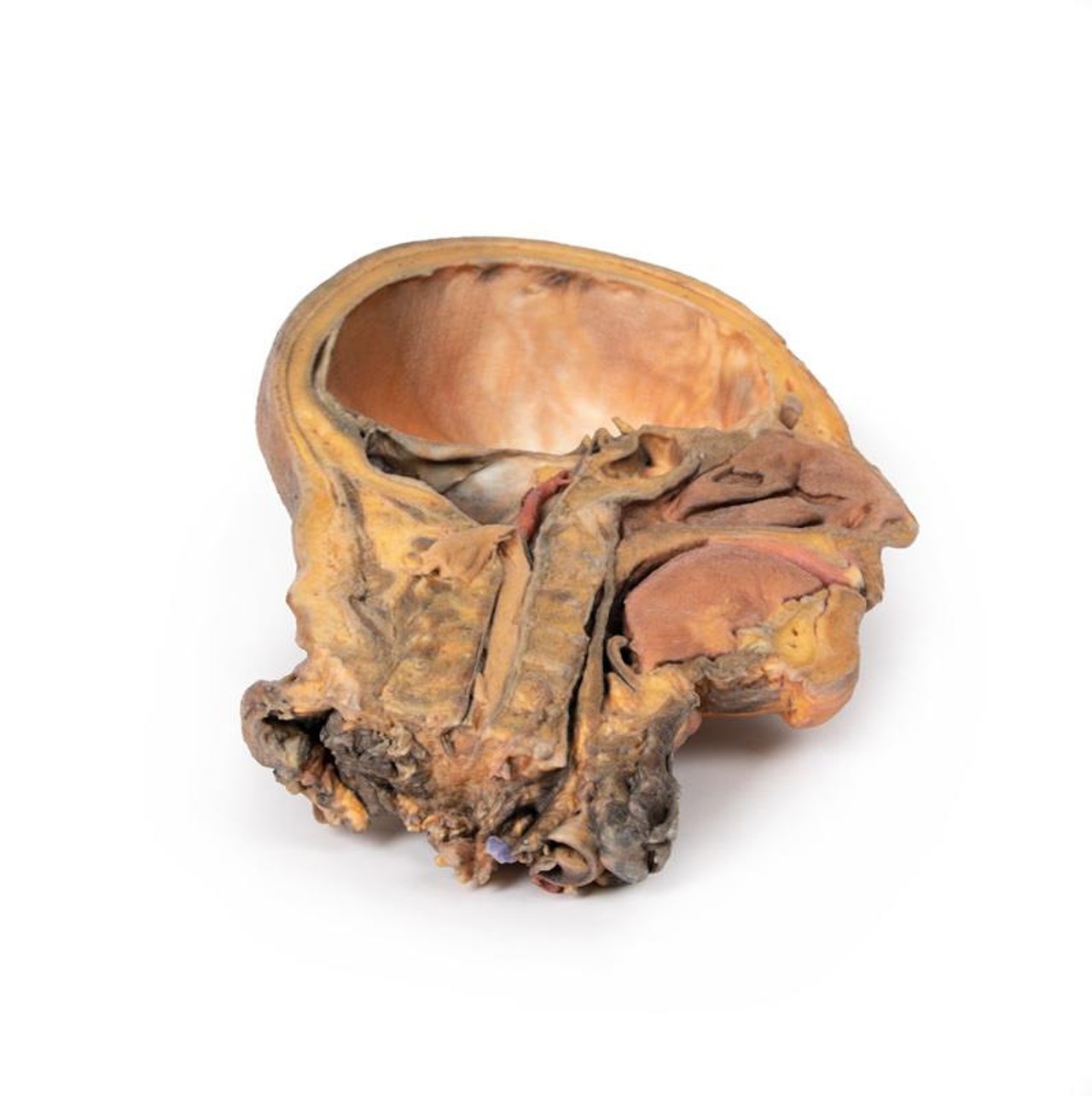 3D Printed Sagittal Section of Head and Neck with Infratemporal Fossa and Carotid Sheath Dissection