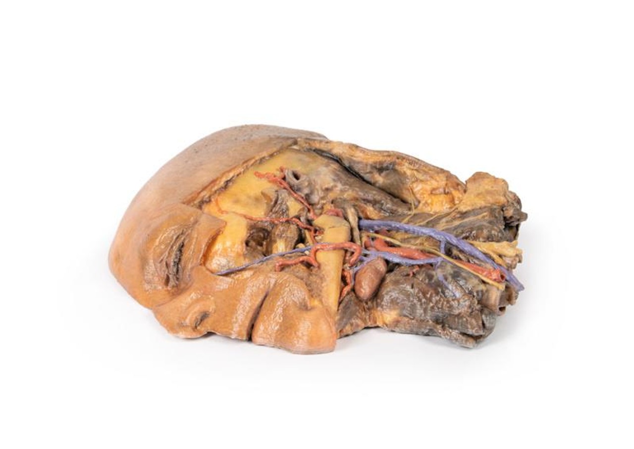 3D Printed Sagittal Section of Head and Neck with Infratemporal Fossa and Carotid Sheath Dissection
