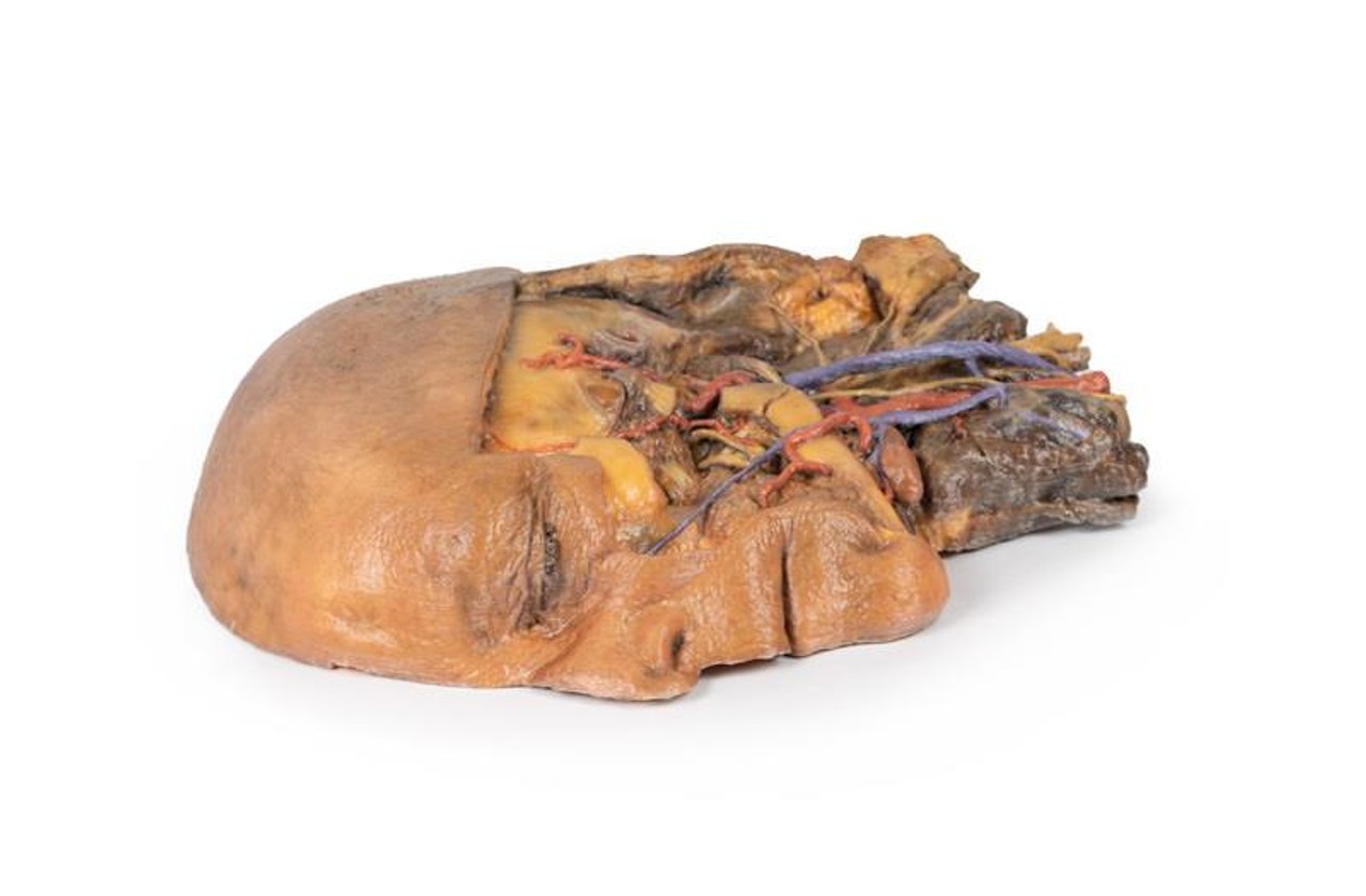 3D Printed Sagittal Section of Head and Neck with Infratemporal Fossa and Carotid Sheath Dissection