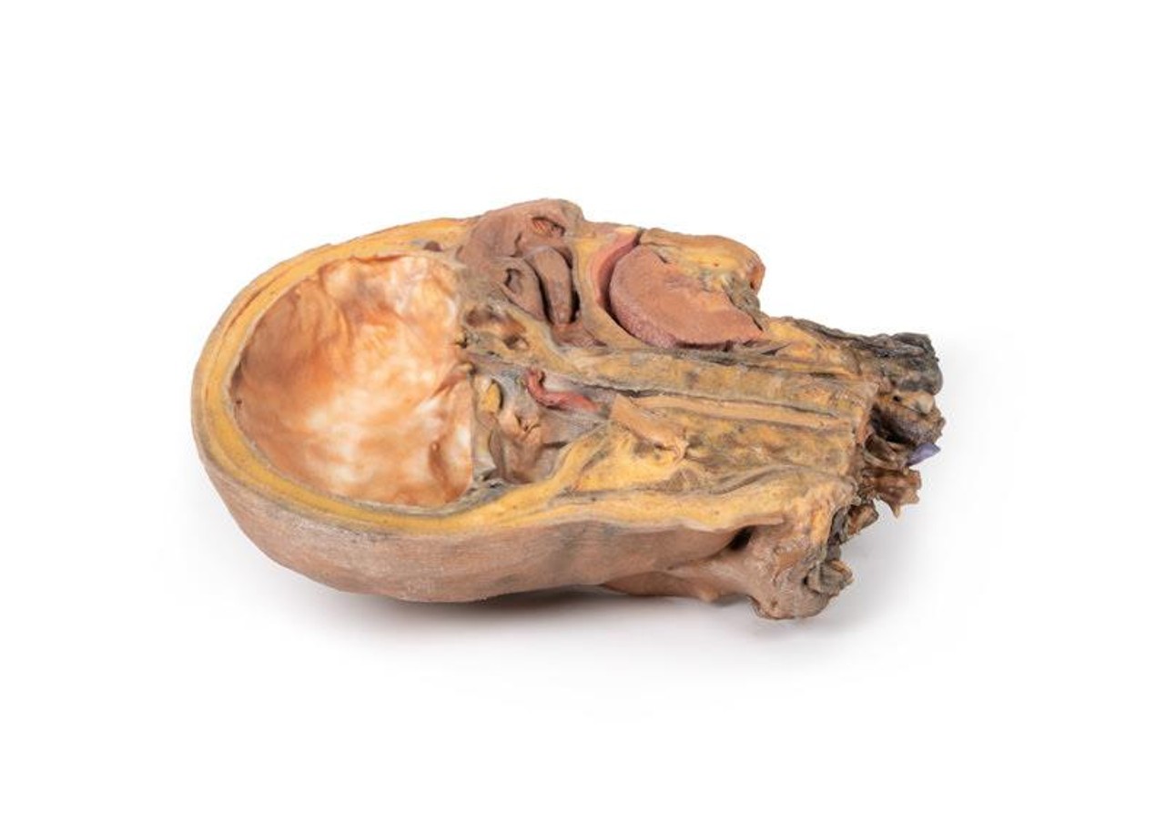 3D Printed Sagittal Section of Head and Neck with Infratemporal Fossa and Carotid Sheath Dissection