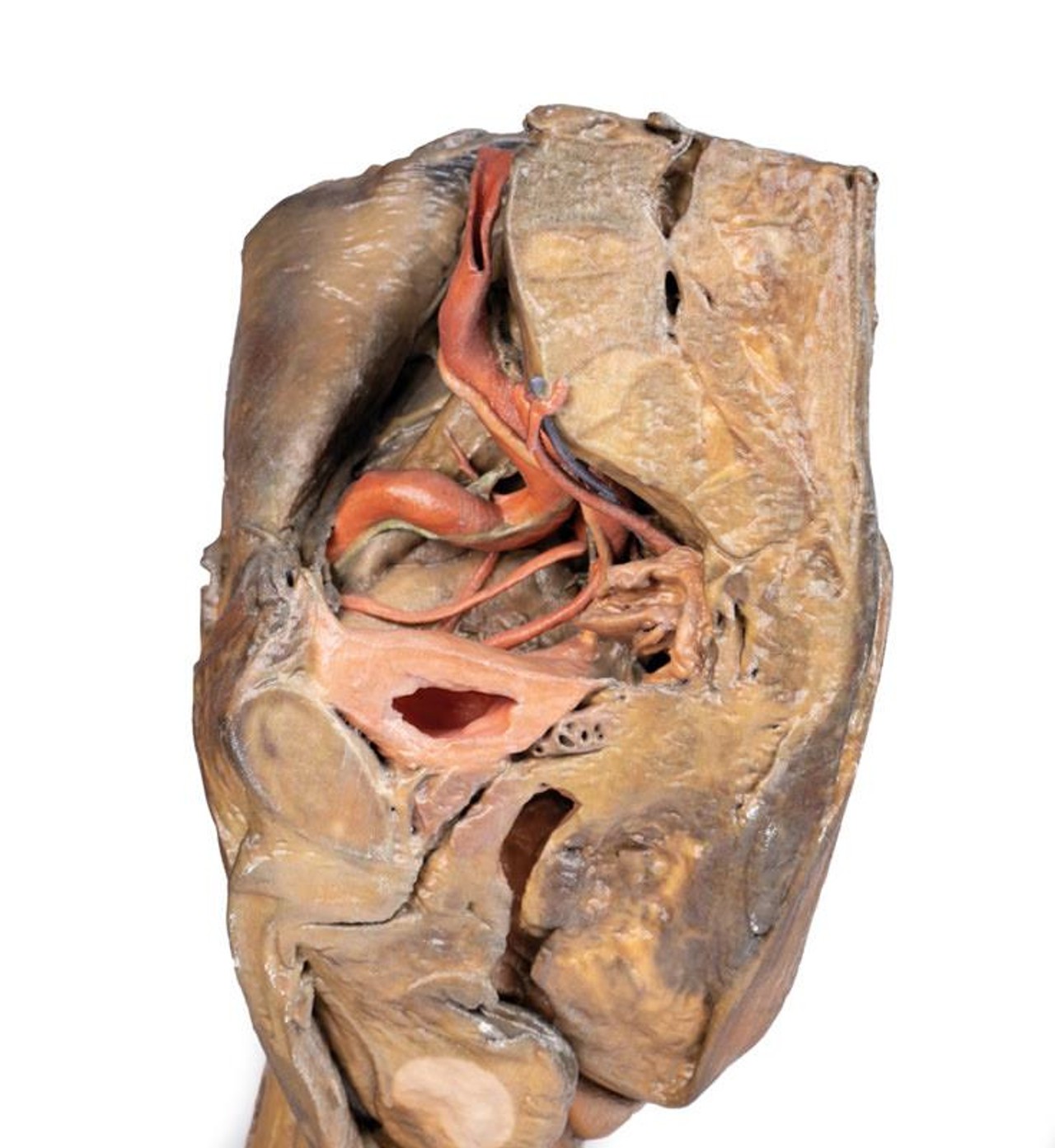 3D Printed Hilum of the Left Lung