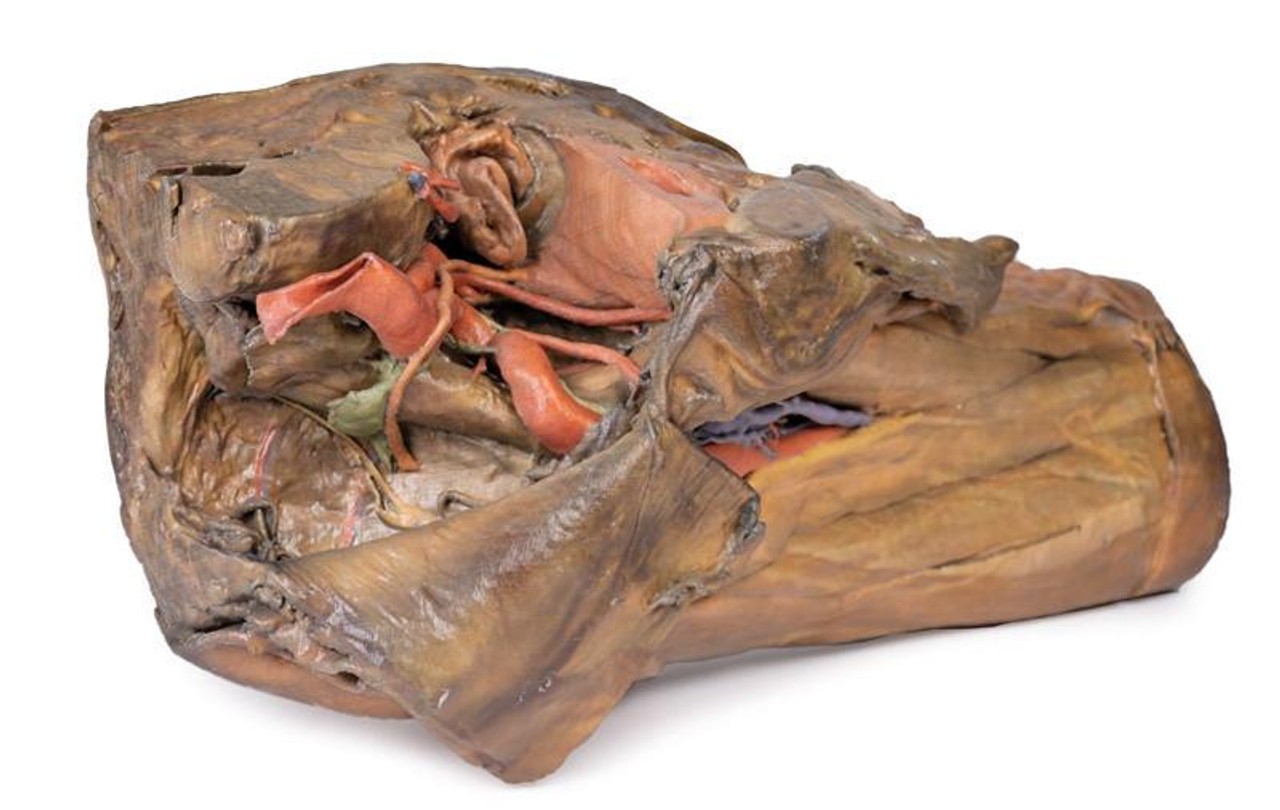 3D Printed Hilum of the Left Lung