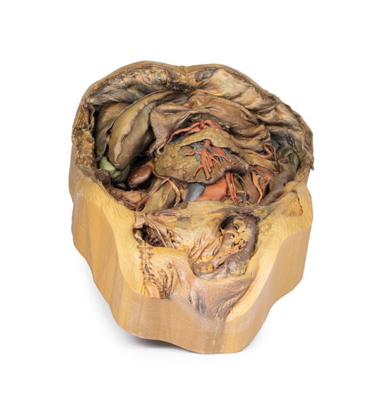 3D Printed Abdomen with Inguinal Hernia