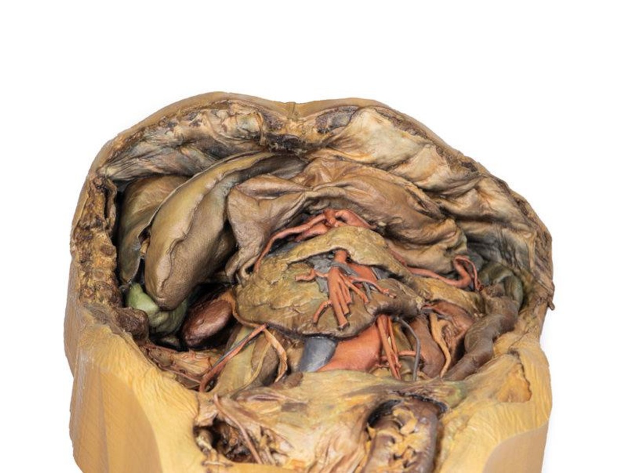 3D Printed Abdomen with Inguinal Hernia