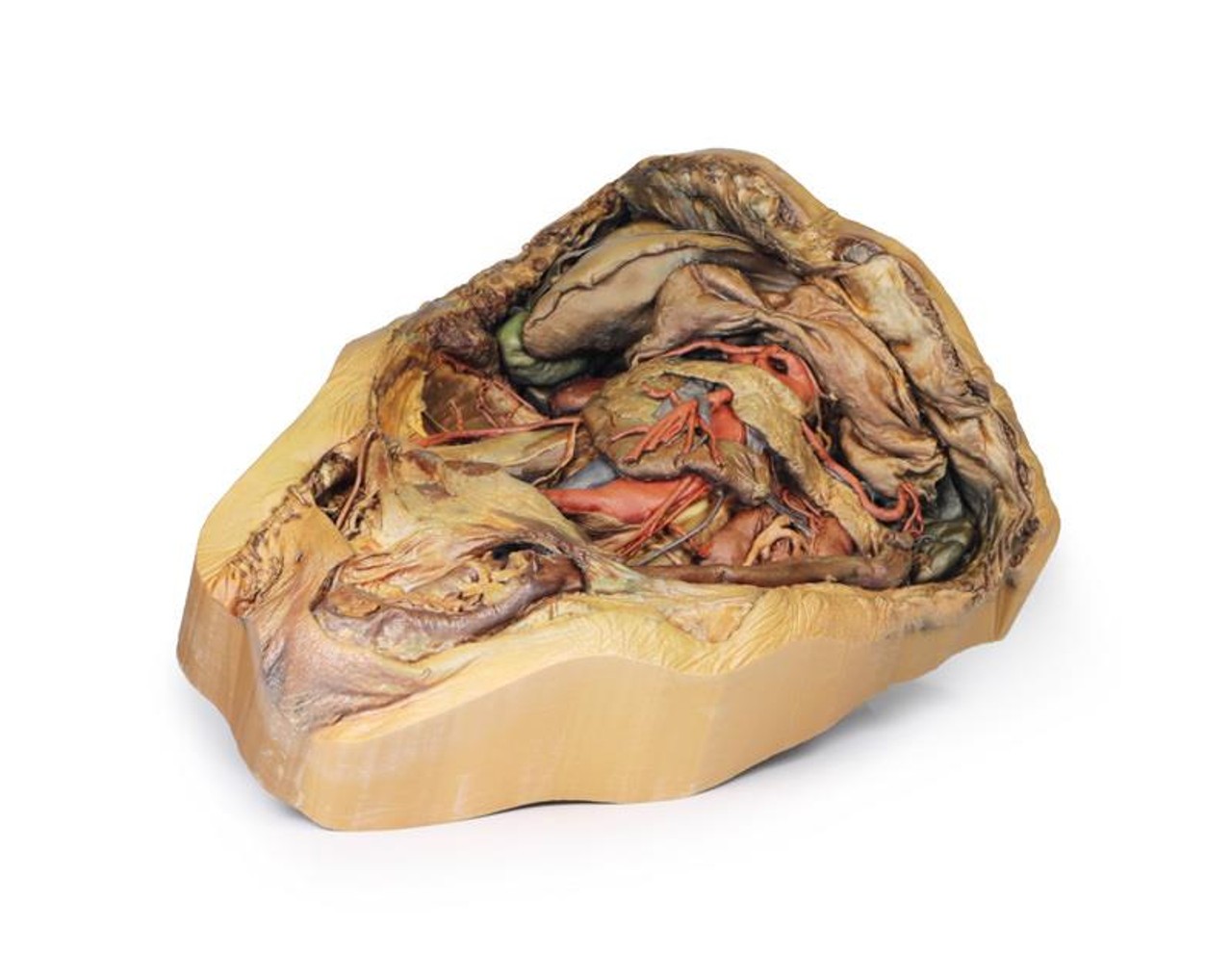 3D Printed Abdomen with Inguinal Hernia