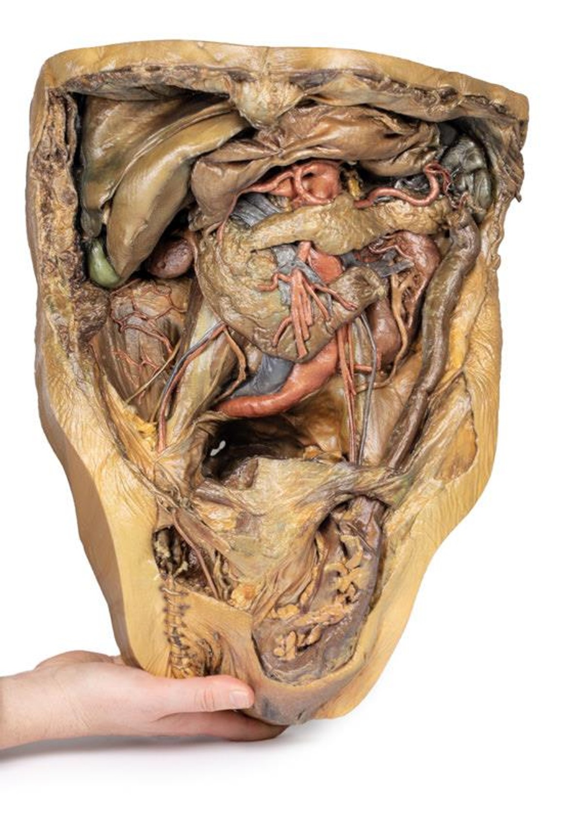 3D Printed Abdomen with Inguinal Hernia
