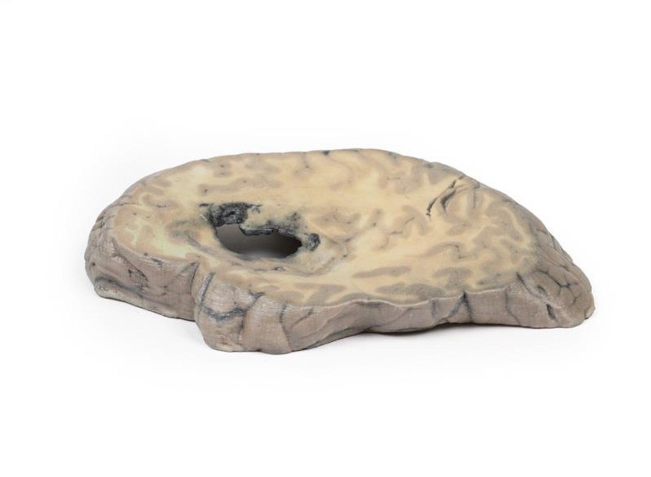 3D Printed Cerebral Haemorrhage