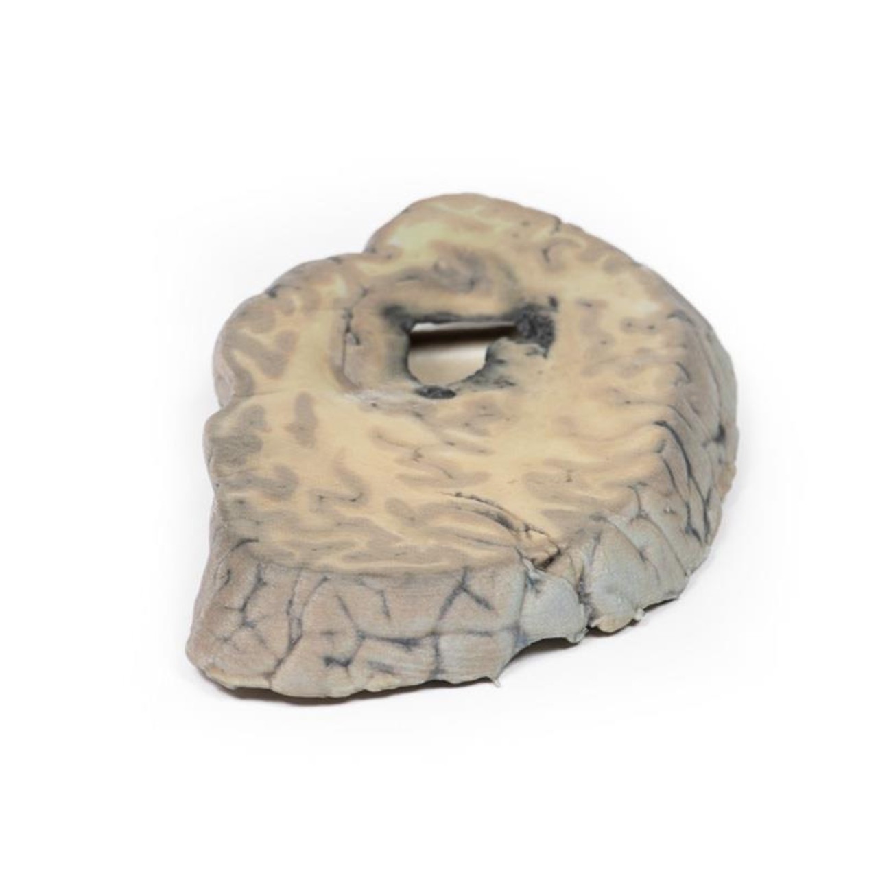 3D Printed Cerebral Haemorrhage