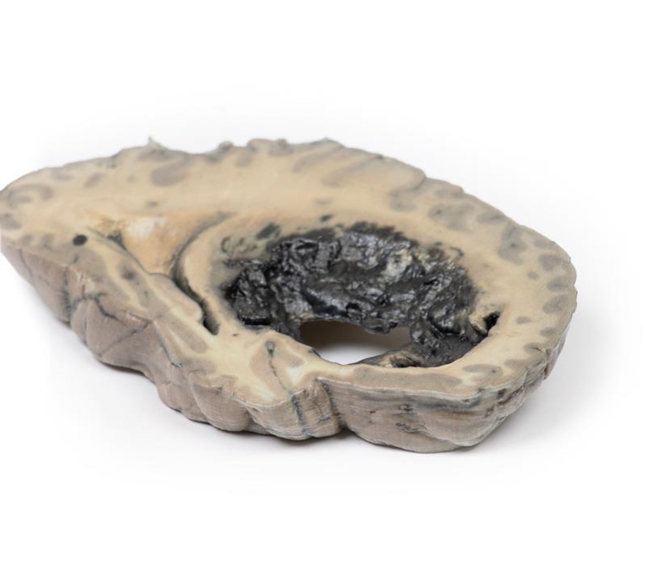 3D Printed Cerebral Haemorrhage