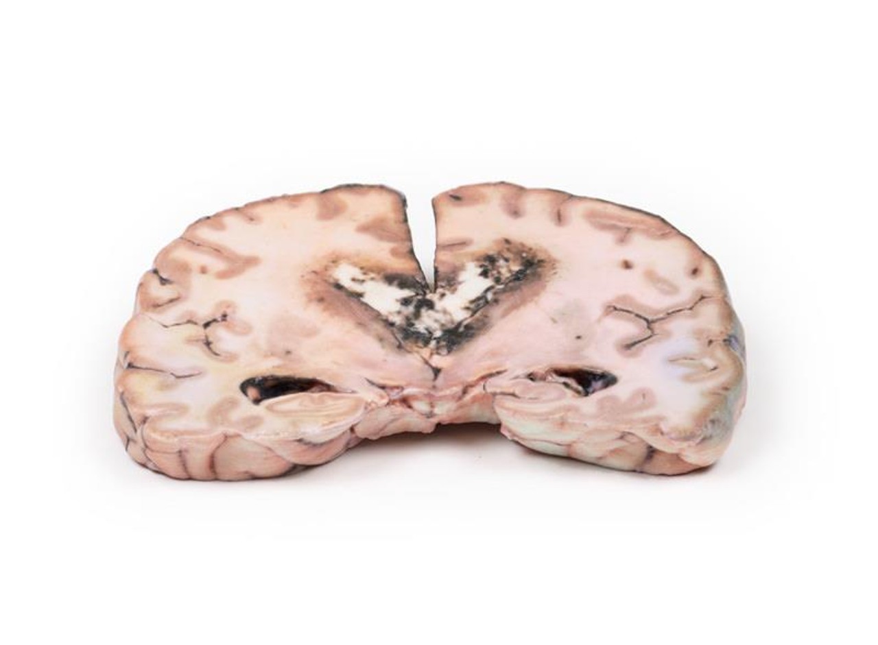 3D Printed Glioma Grade 3-4 Caused Papilloedema