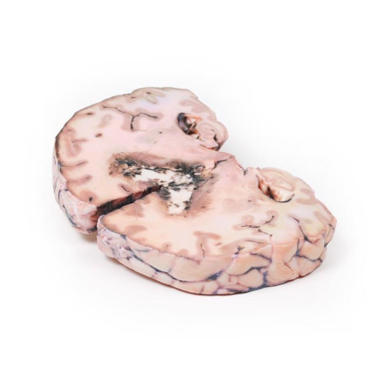 3D Printed Glioma Grade 3-4 Caused Papilloedema