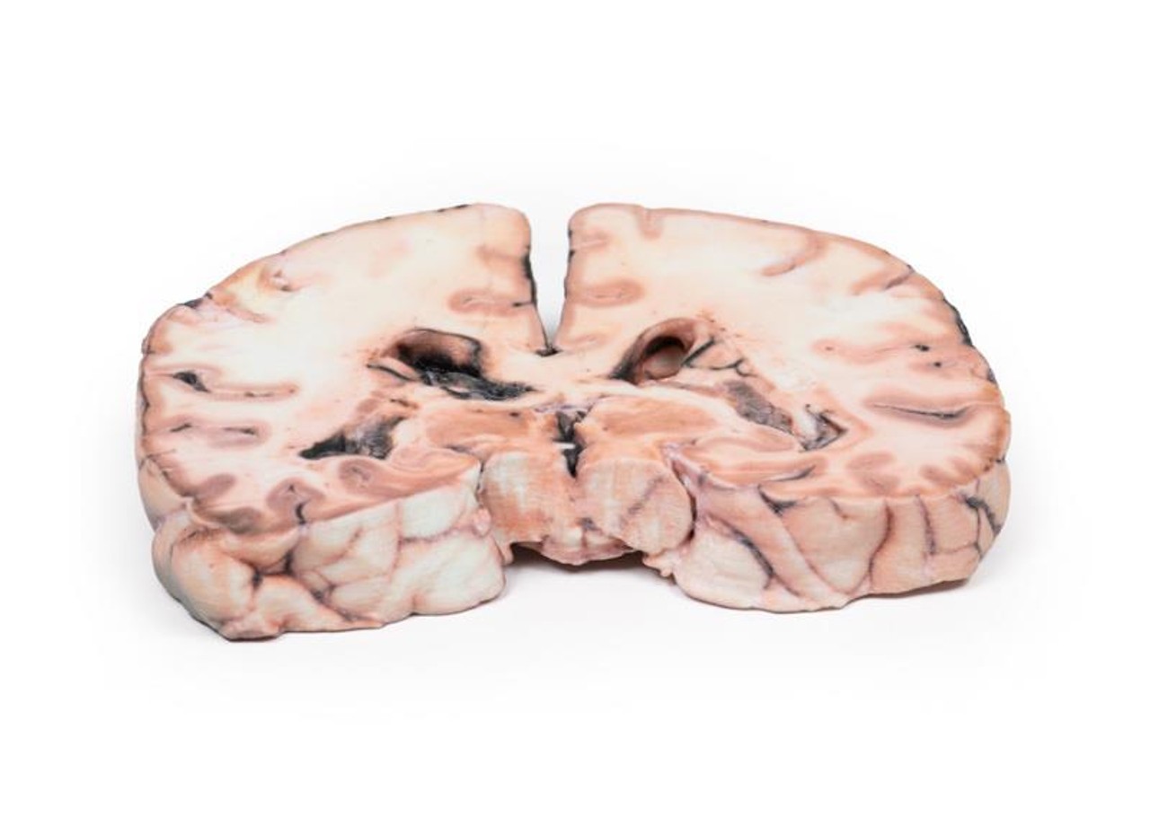 3D Printed Glioma Grade 3-4 Caused Papilloedema