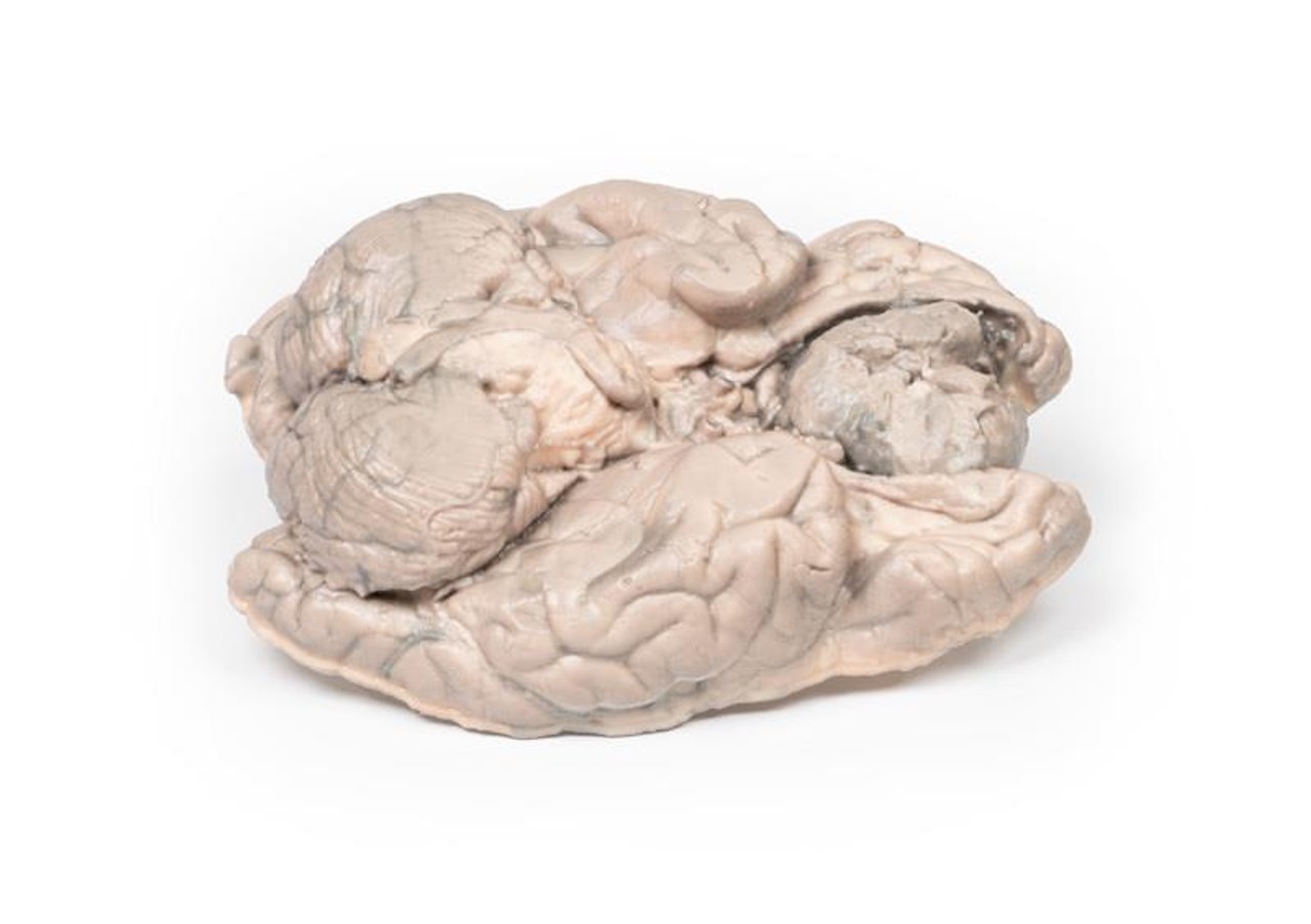 3D Printed Meningioma