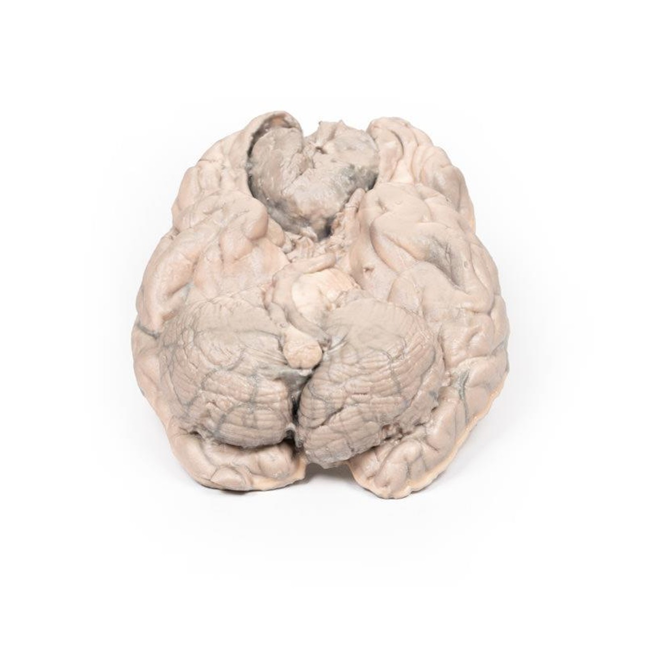 3D Printed Meningioma