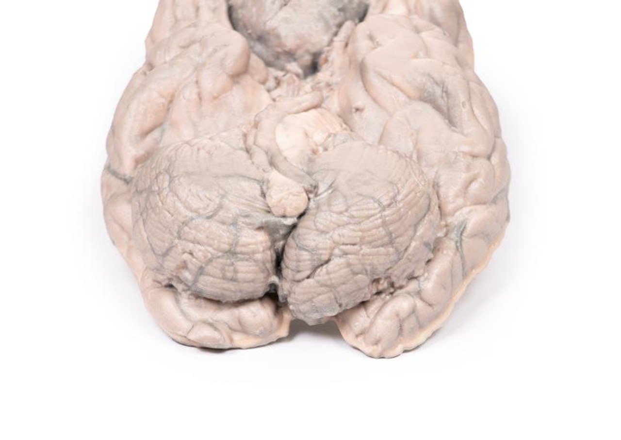 3D Printed Meningioma