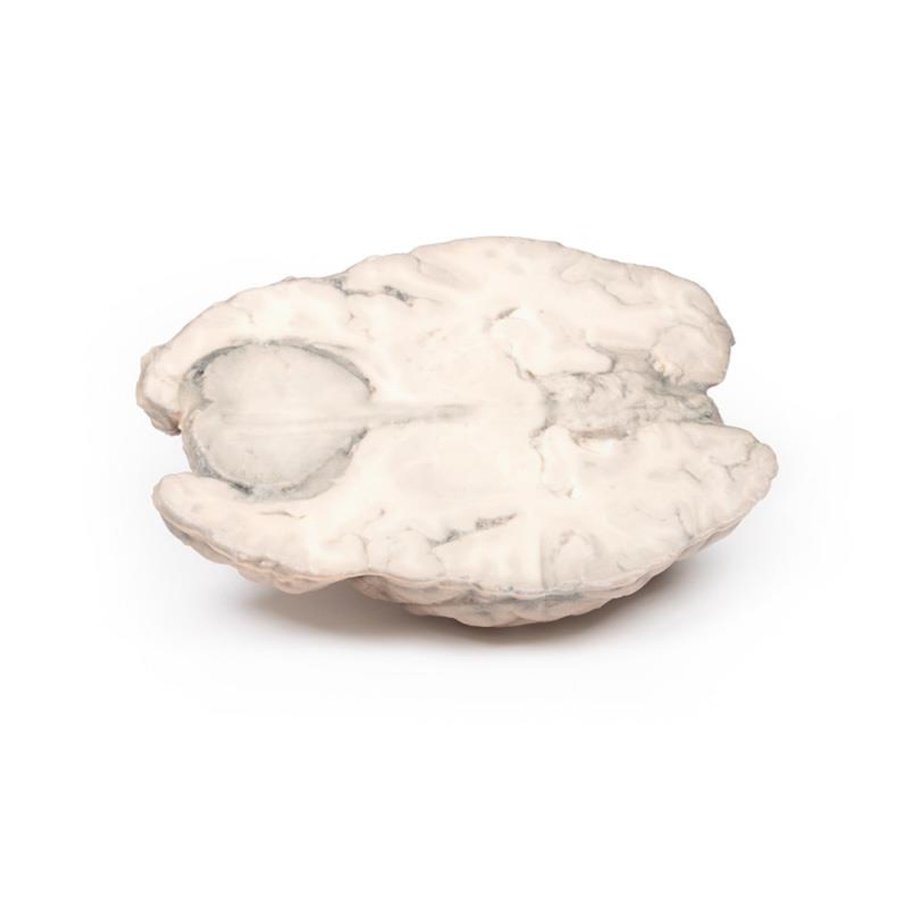 3D Printed Meningioma