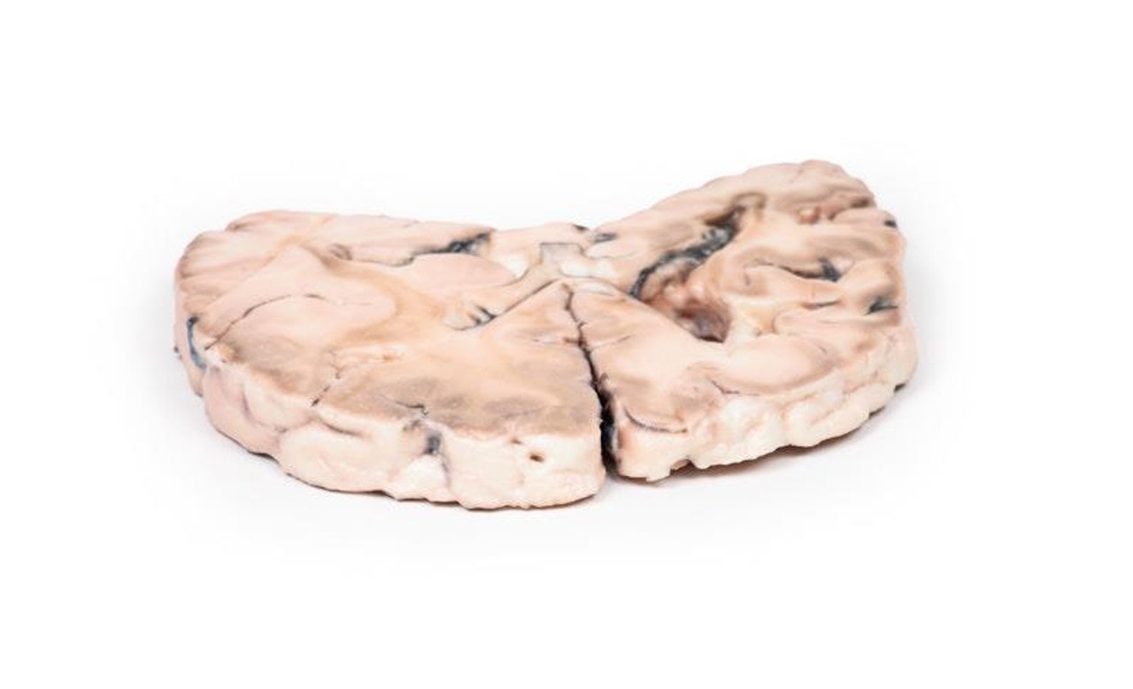 3D Printed Left Cerebral Infarct