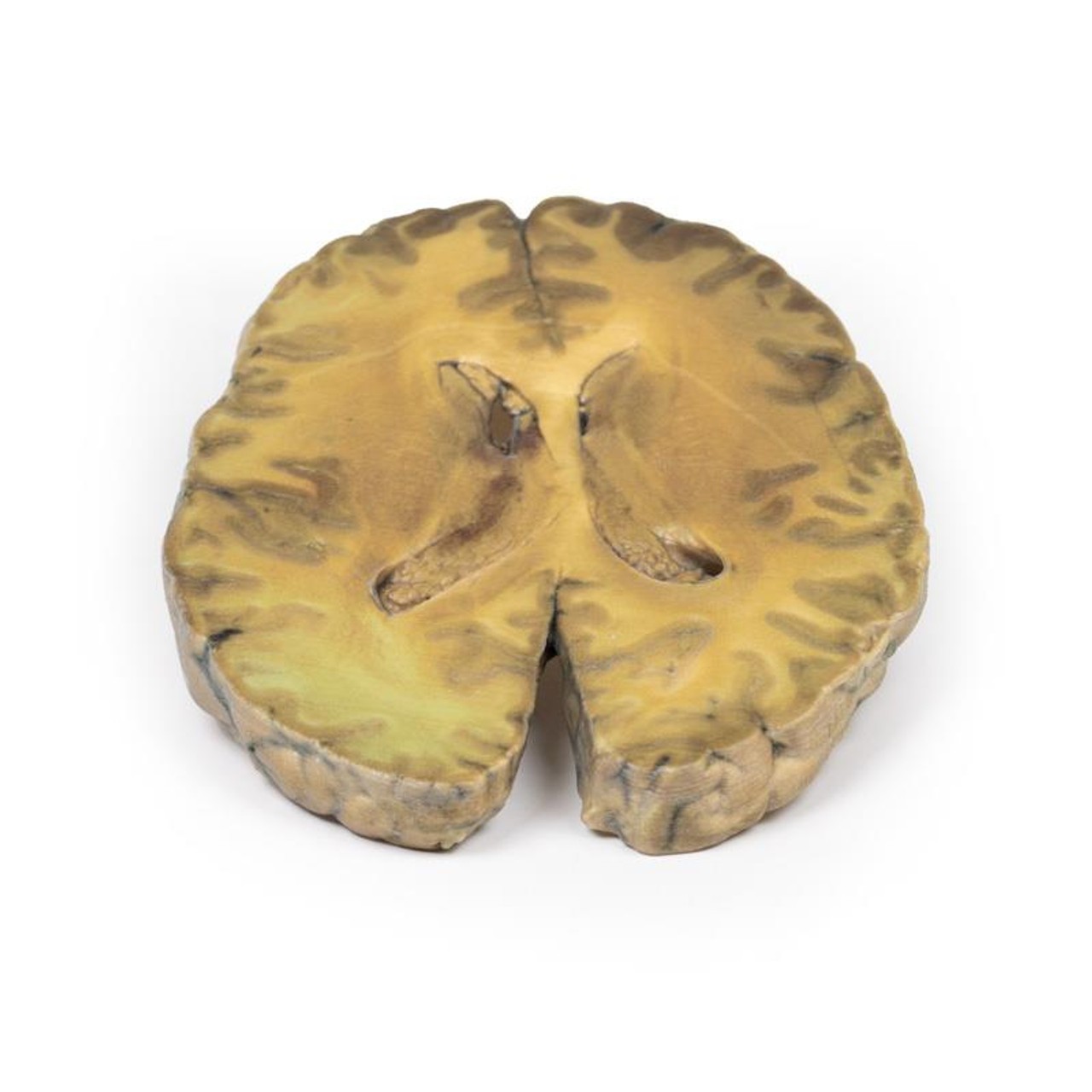 3D Printed Ventriculitis, Secondary to Septicaemia