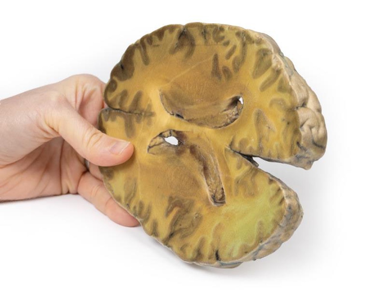 3D Printed Ventriculitis, Secondary to Septicaemia