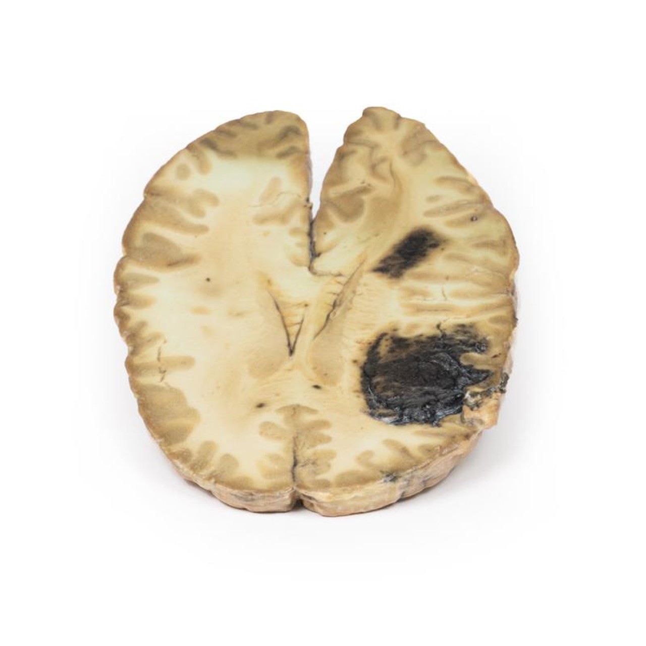 3D Printed Cerebral Haemorrhage, Secondary to Acute Myeloid Leukaemia