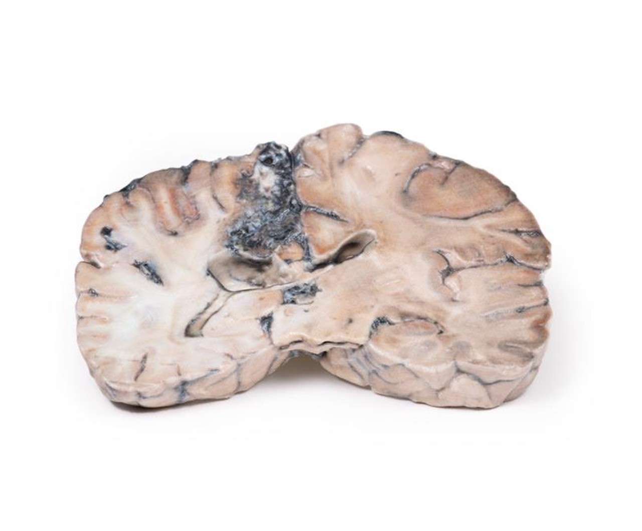 3D Printed Cerebral Arterio-Venous Malformation