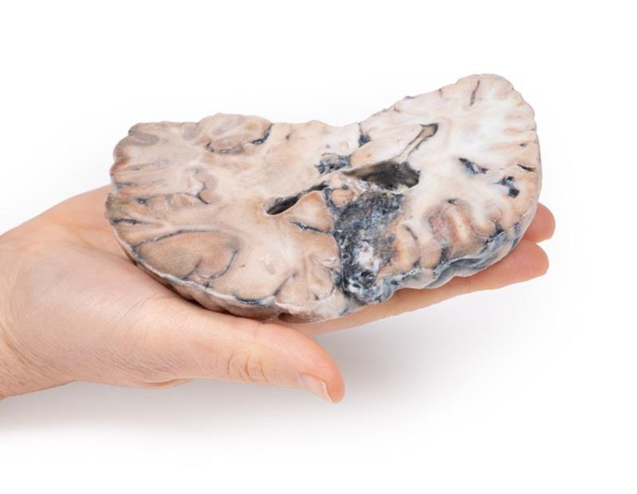 3D Printed Cerebral Arterio-Venous Malformation