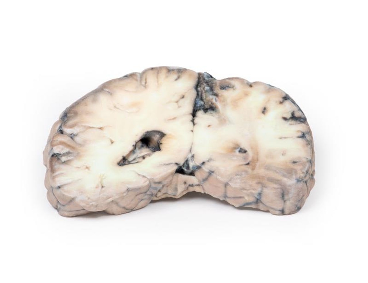 3D Printed Cerebral Arterio-Venous Malformation