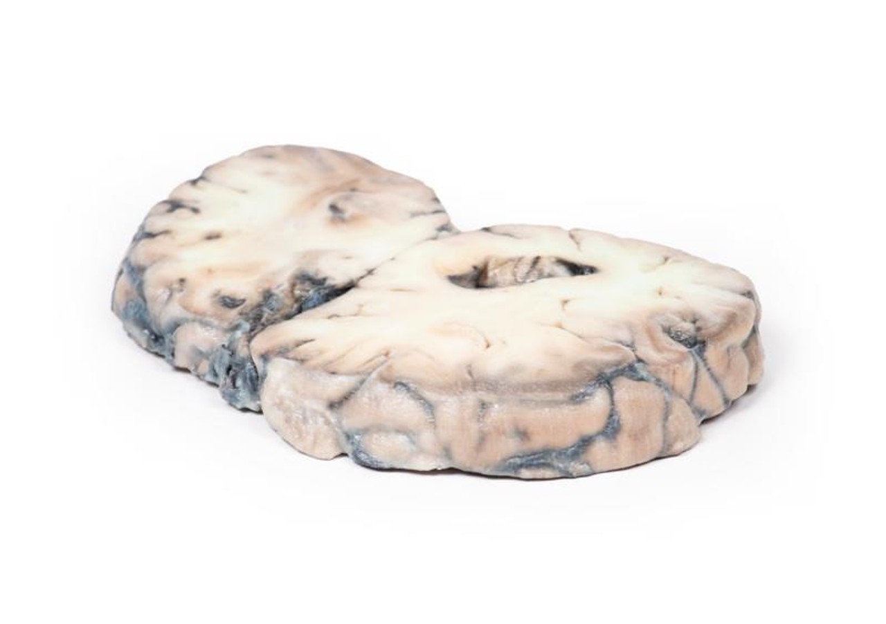 3D Printed Cerebral Arterio-Venous Malformation