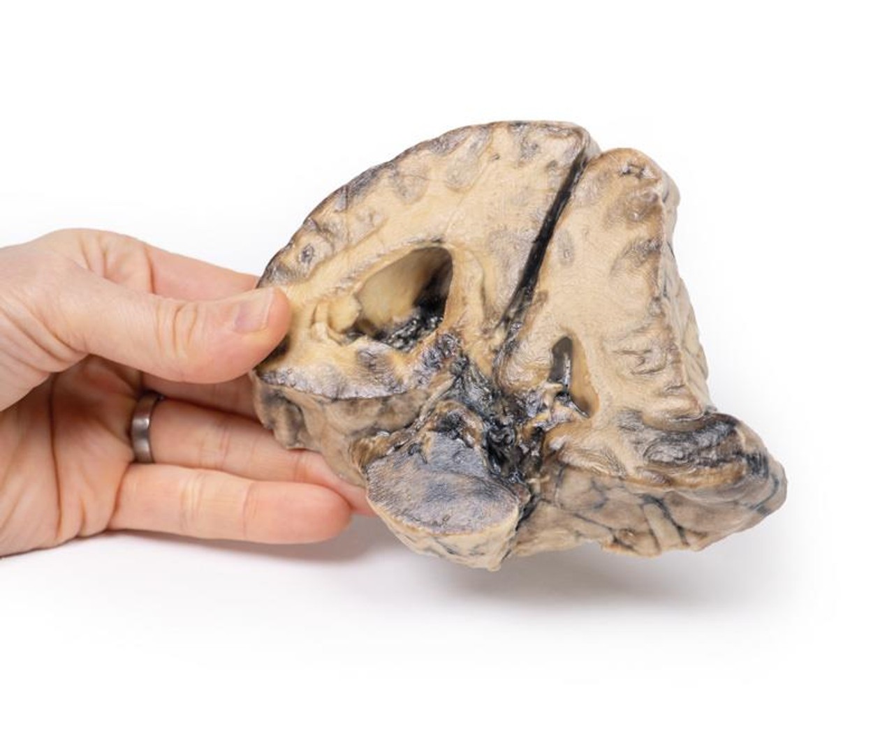 3D Printed Intracranial Space-Occupying Lesion