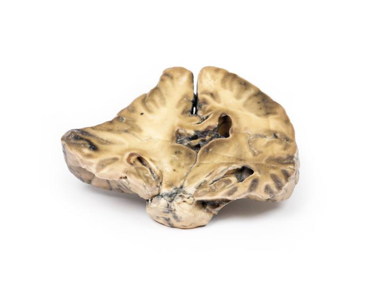 3D Printed Intracranial Space-Occupying Lesion