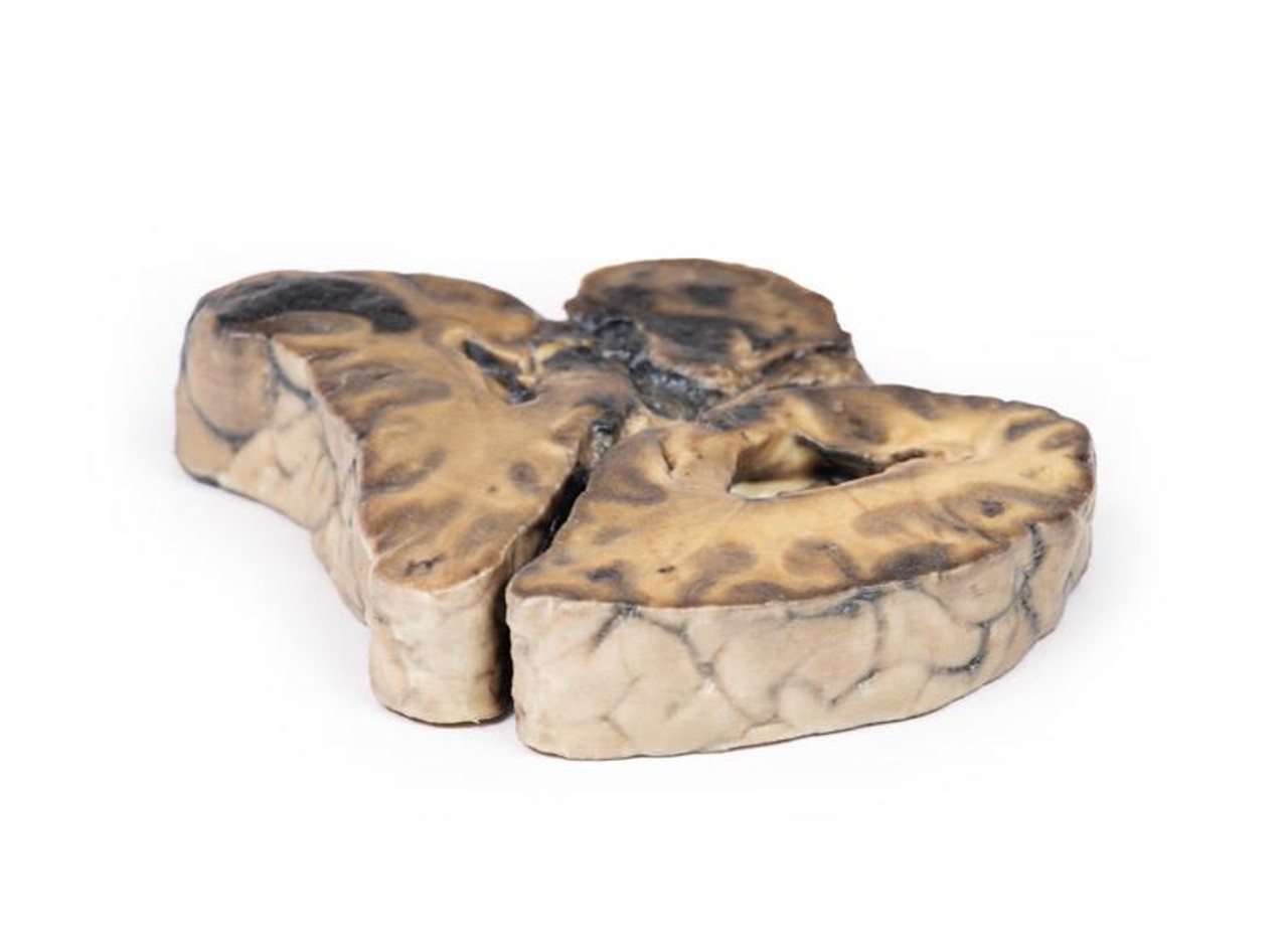 3D Printed Intracranial Space-Occupying Lesion
