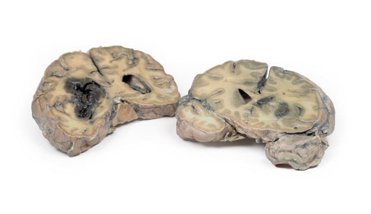 3D Printed Intracerebral Haemorrhage