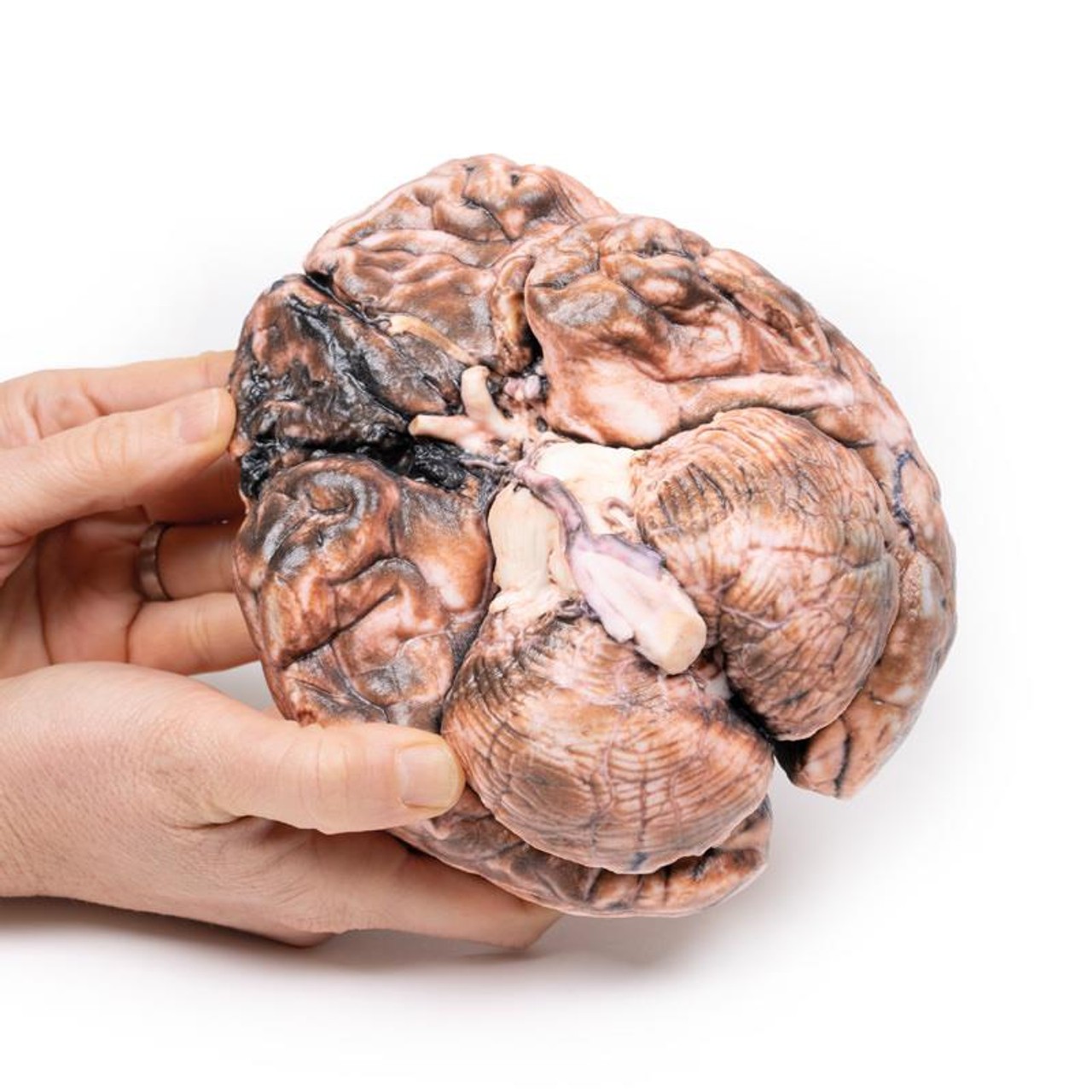 3D Printed Ruptured Berry Aneurysm