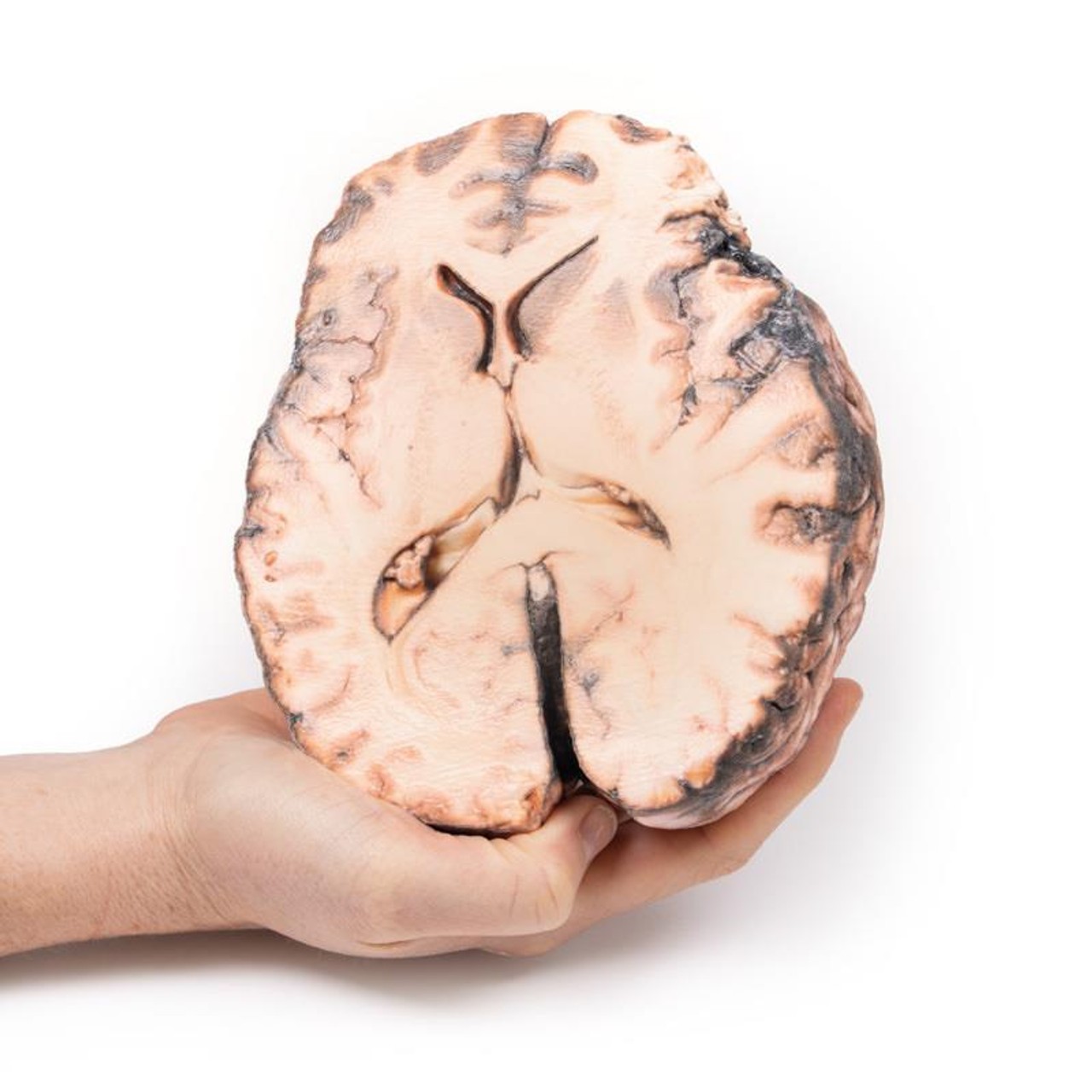 3D Printed Ruptured Berry Aneurysm