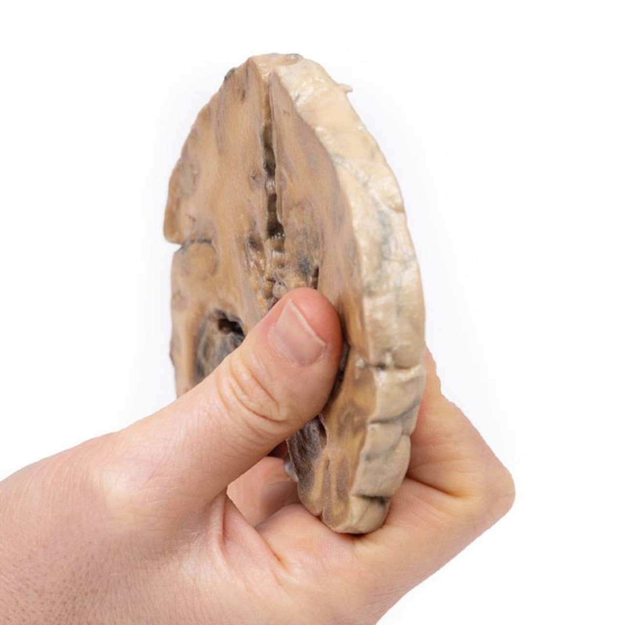 3D Printed Glioblastoma Multiforme in Left Temporal Lobe