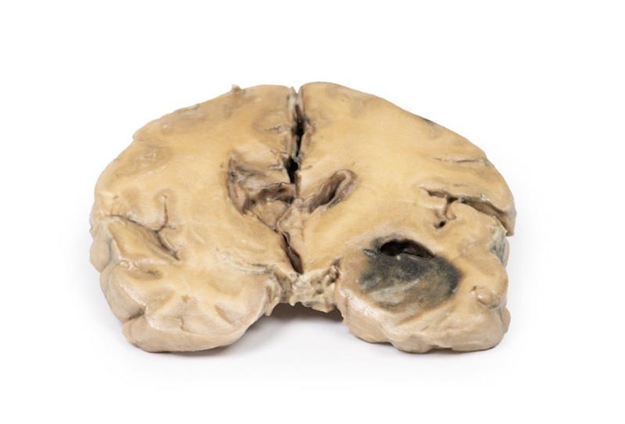 3D Printed Glioblastoma Multiforme in Left Temporal Lobe